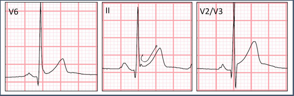 ST elevation can be clearly seen in the above leads. Lead II has J point notching (i.e. “fishhook”), characteristic of early repolarization.