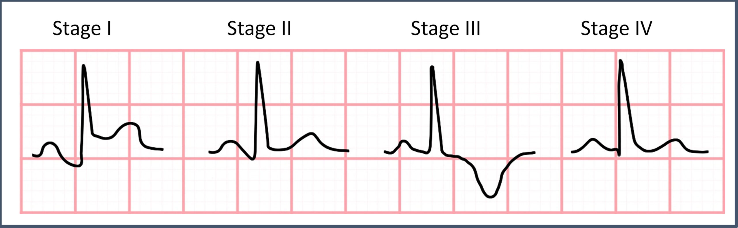 Morphologic features of the various stages of pericarditis.