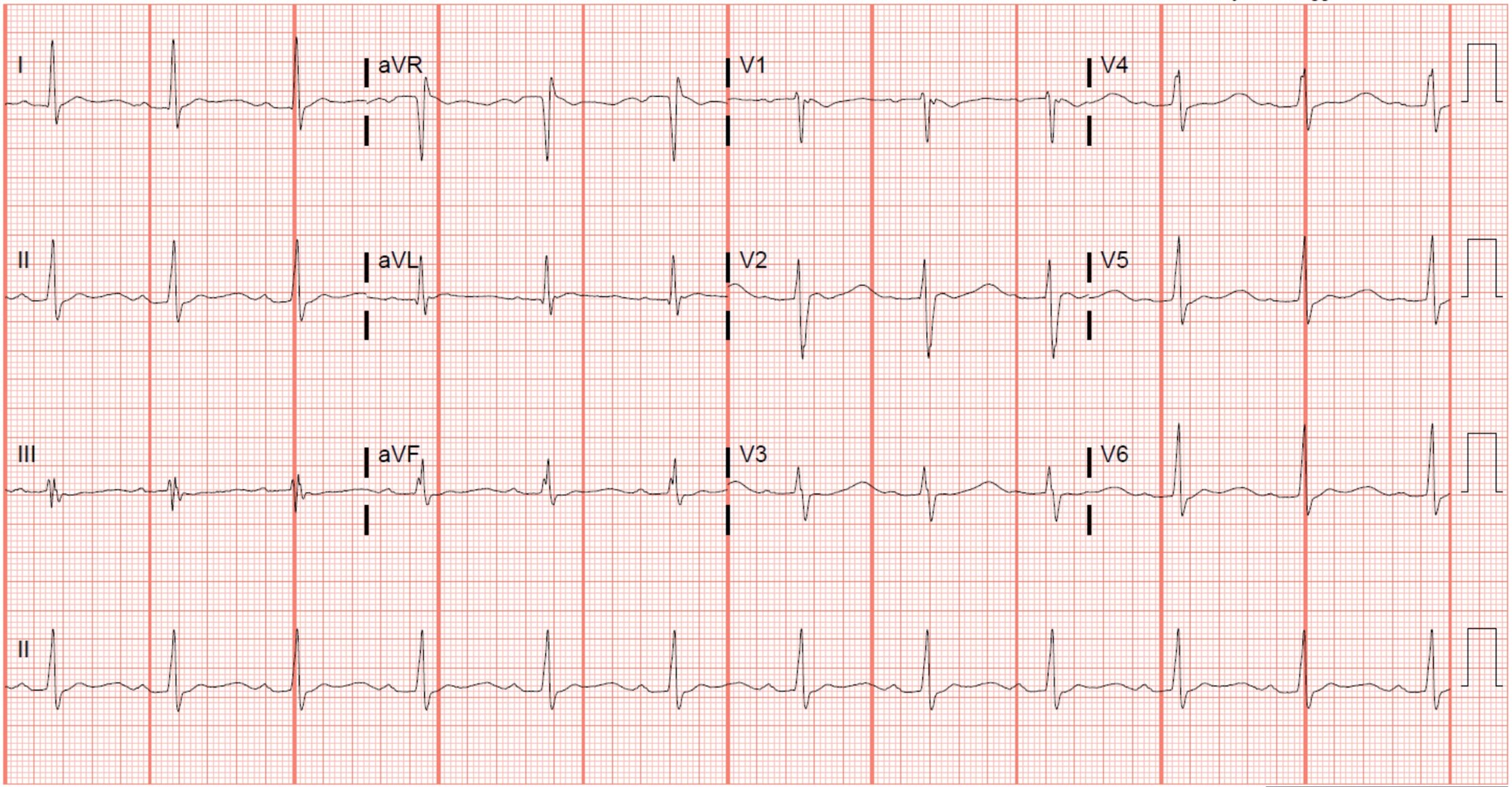 JUCM ECG Case #4