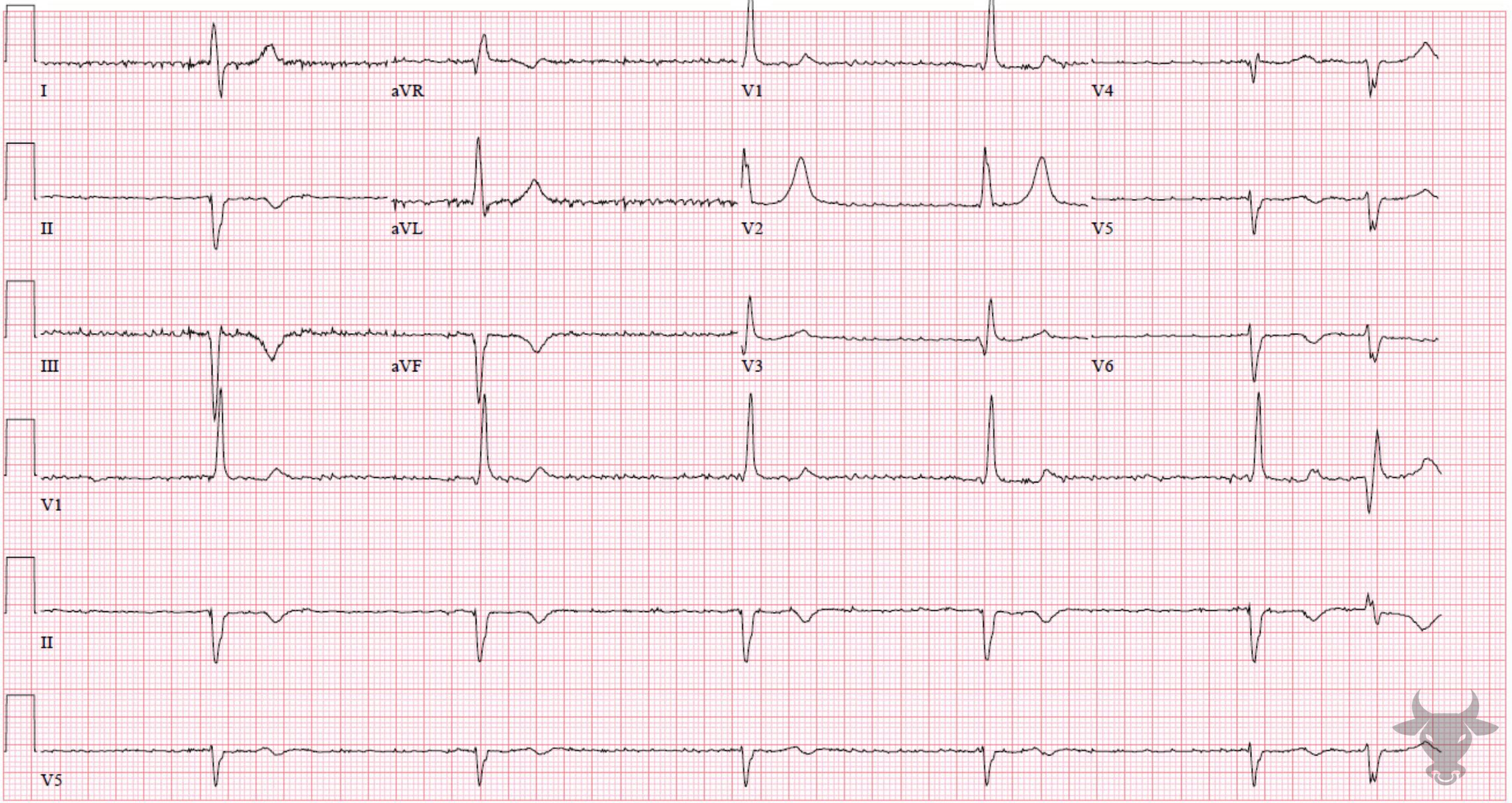 ECG Showing Third Degree Atrioventricular Block