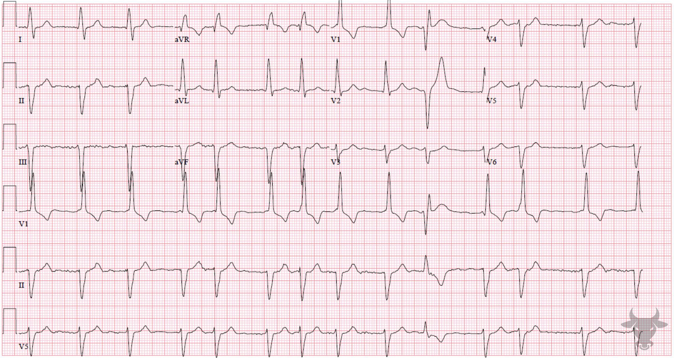 ECG Showing Bifascicular Block