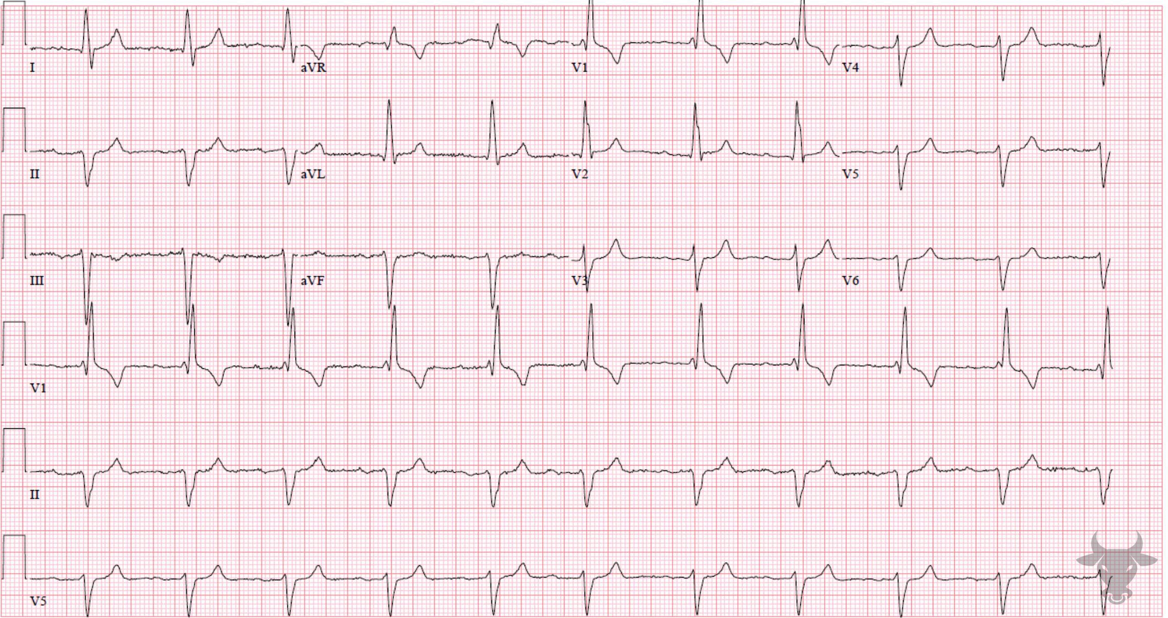 ECG Showing Trifascicular Block