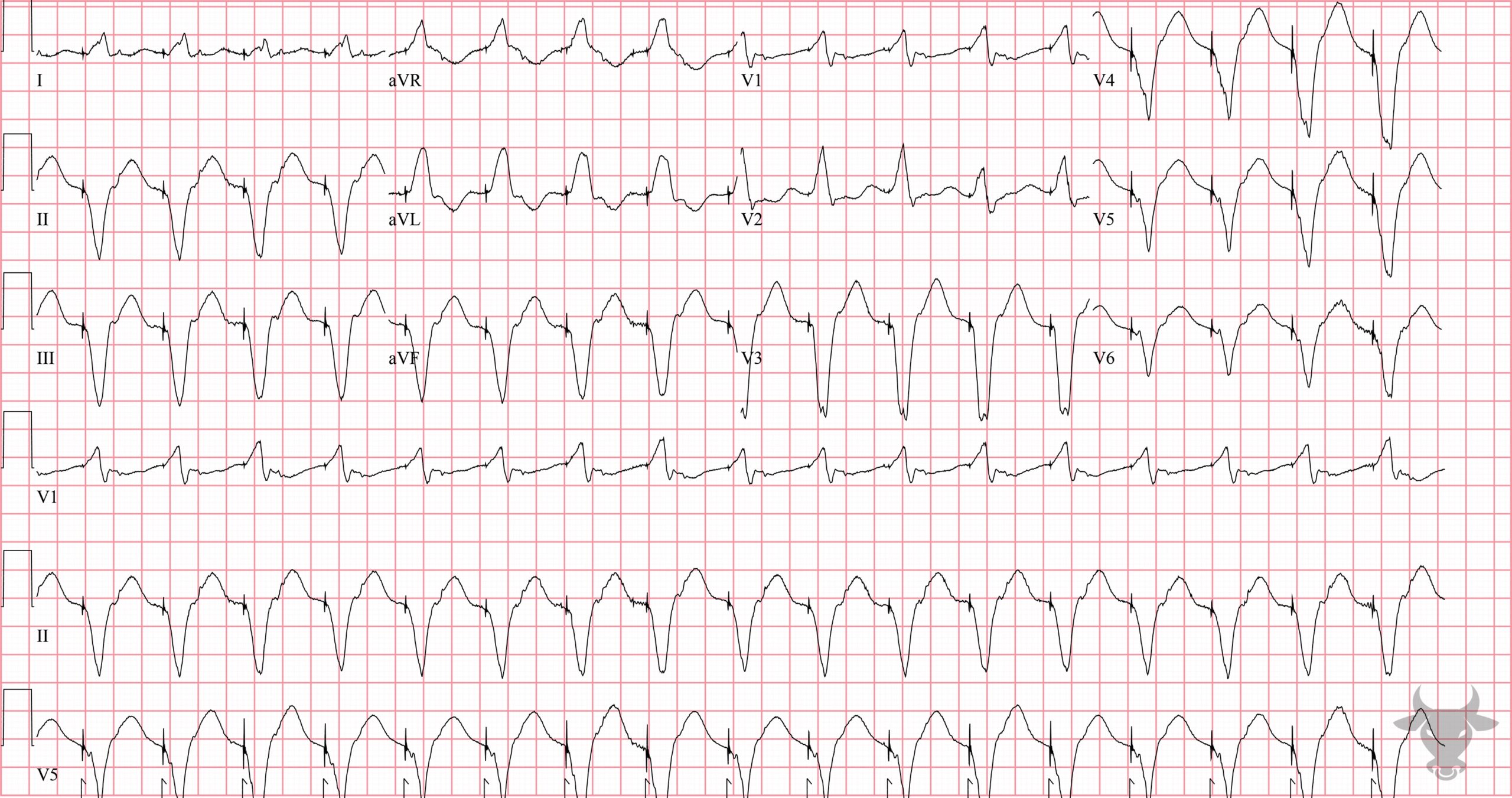 ECG Showing Pacemaker Mediated Tachycardia