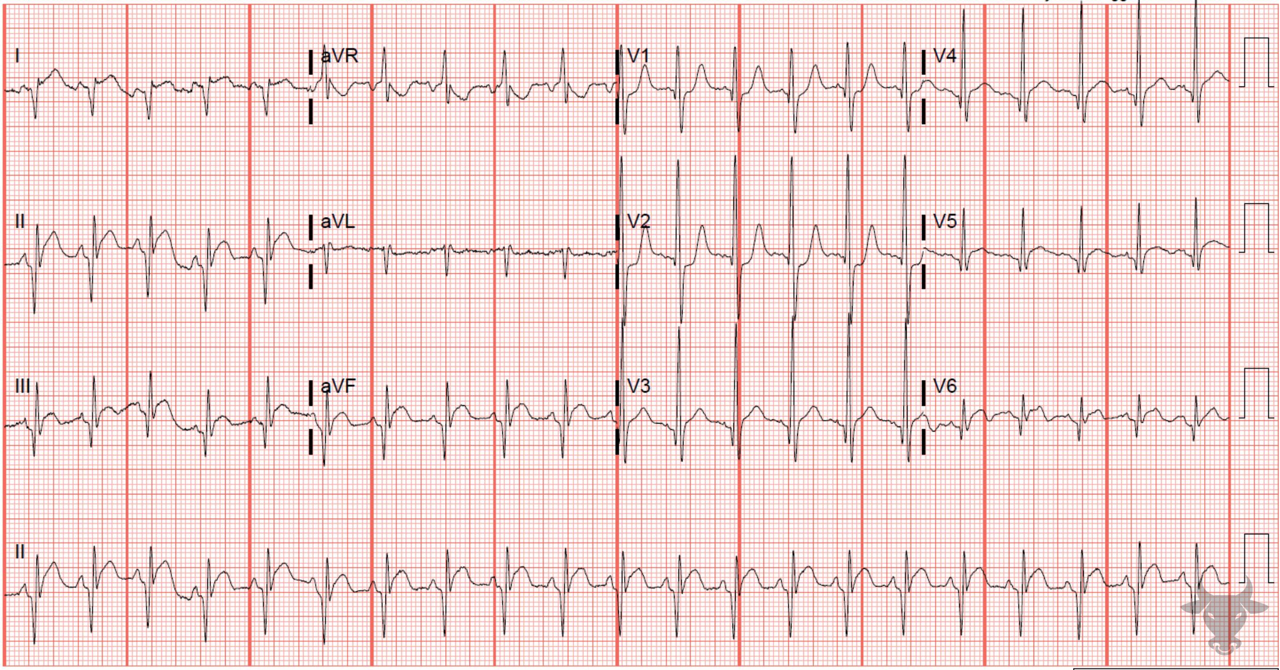 ECG Showing Dextrocardia