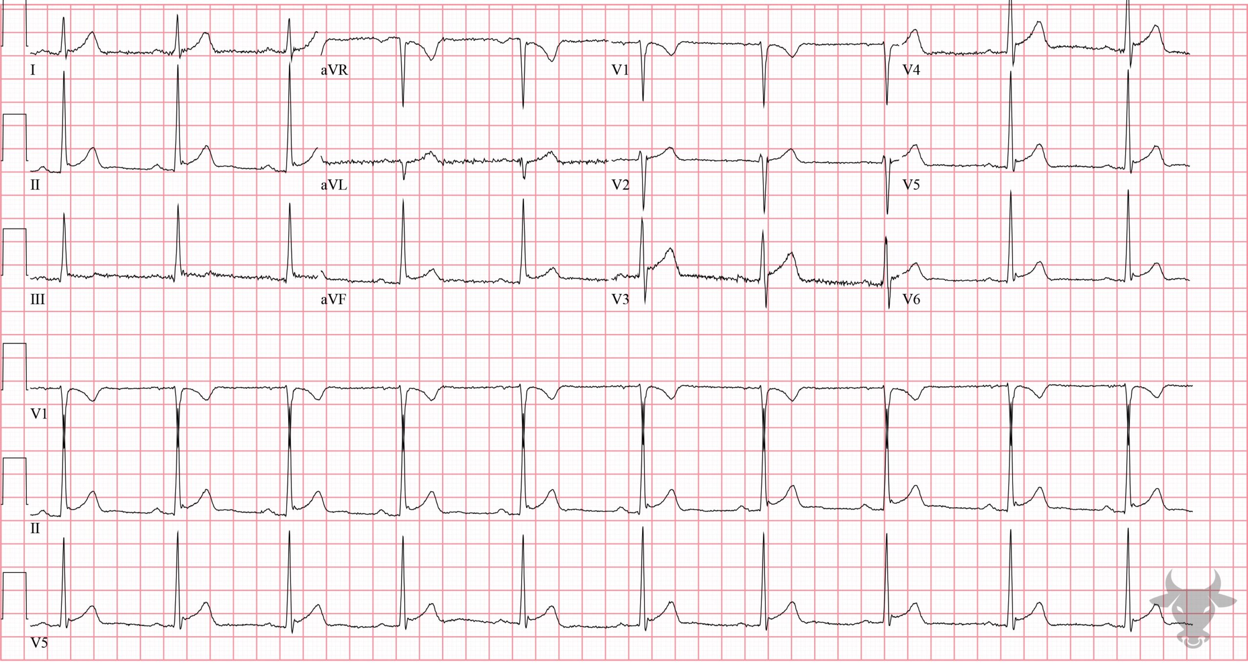 ECG Showing Early Repolarization