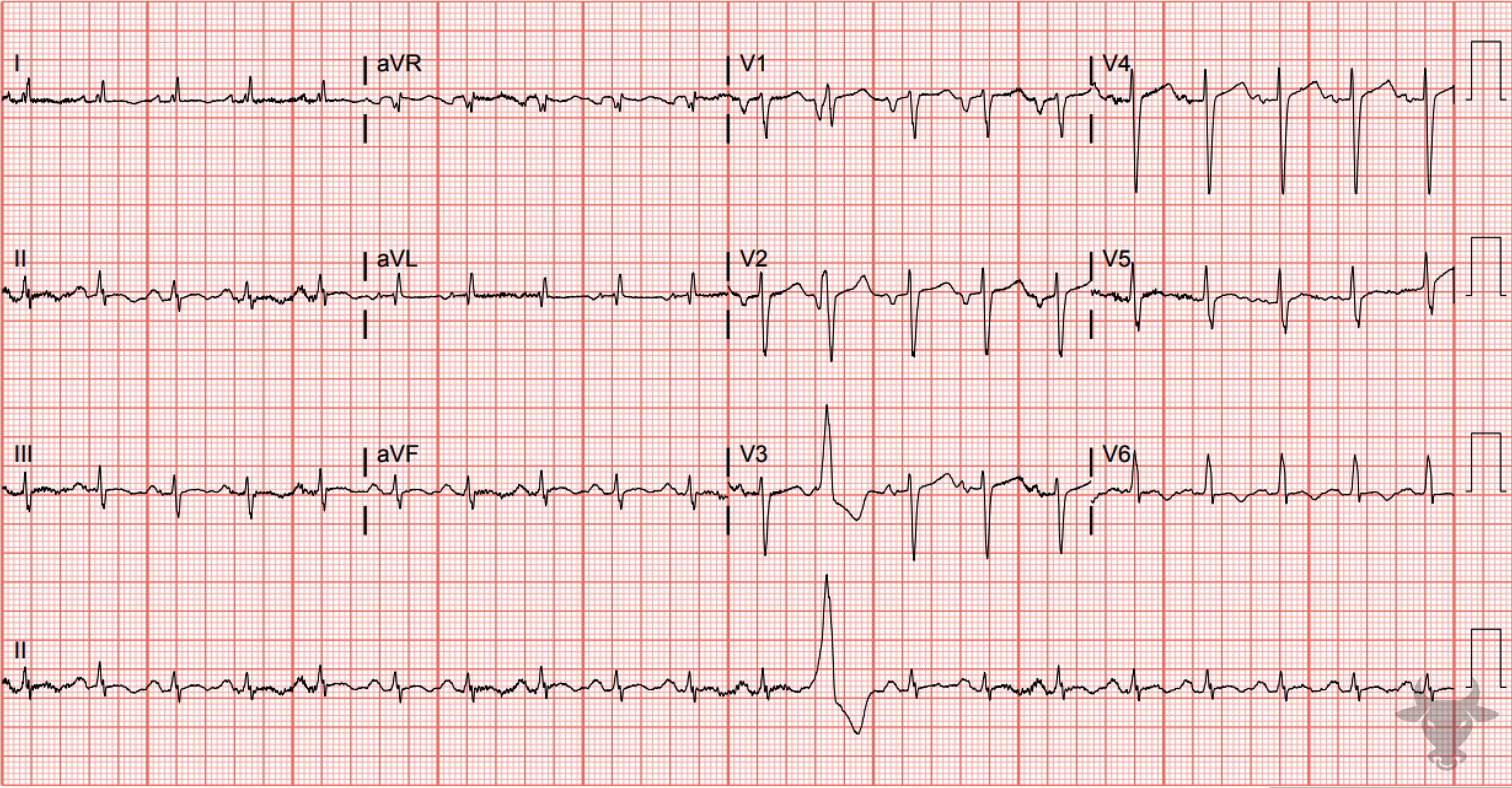 ECG Showing Left Atrial Enlargement