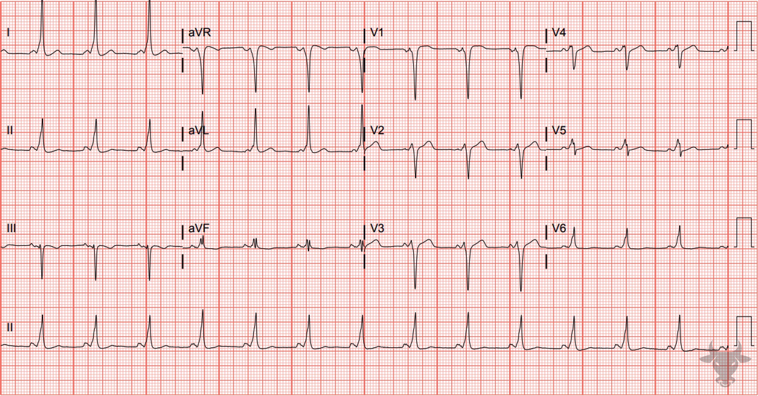 ECG Showing Ventricular Pre-excitation