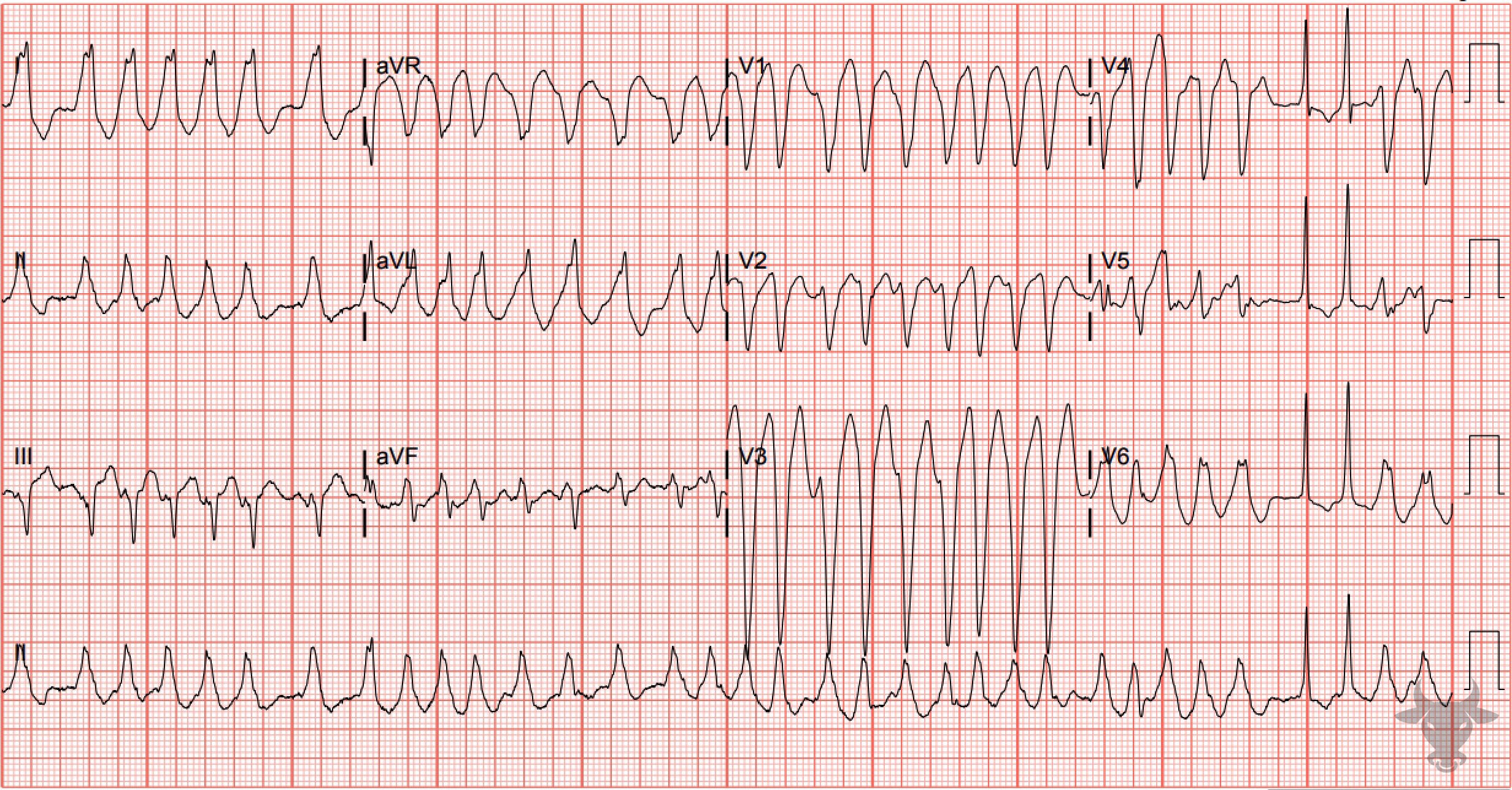 ECG Showing Atrial Fibrillation with WPW