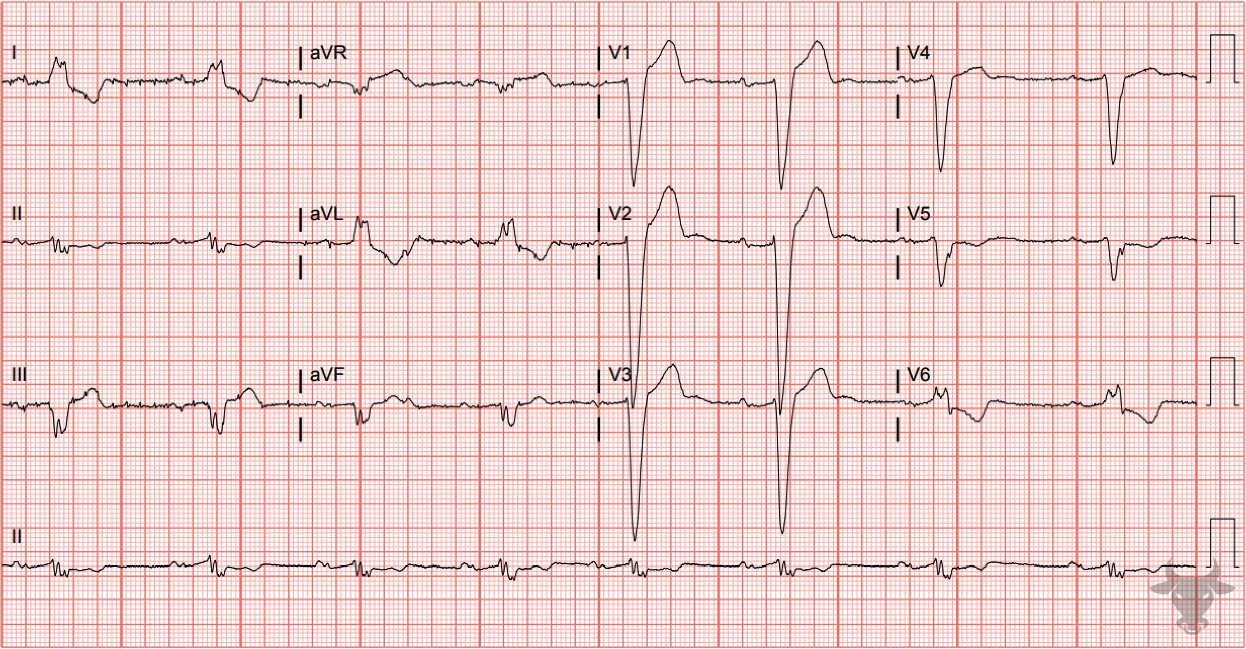 ECG Showing Left Bundle Branch Block