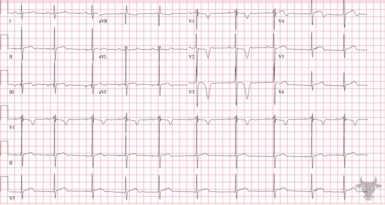 T-wave Inversions | ECG Stampede