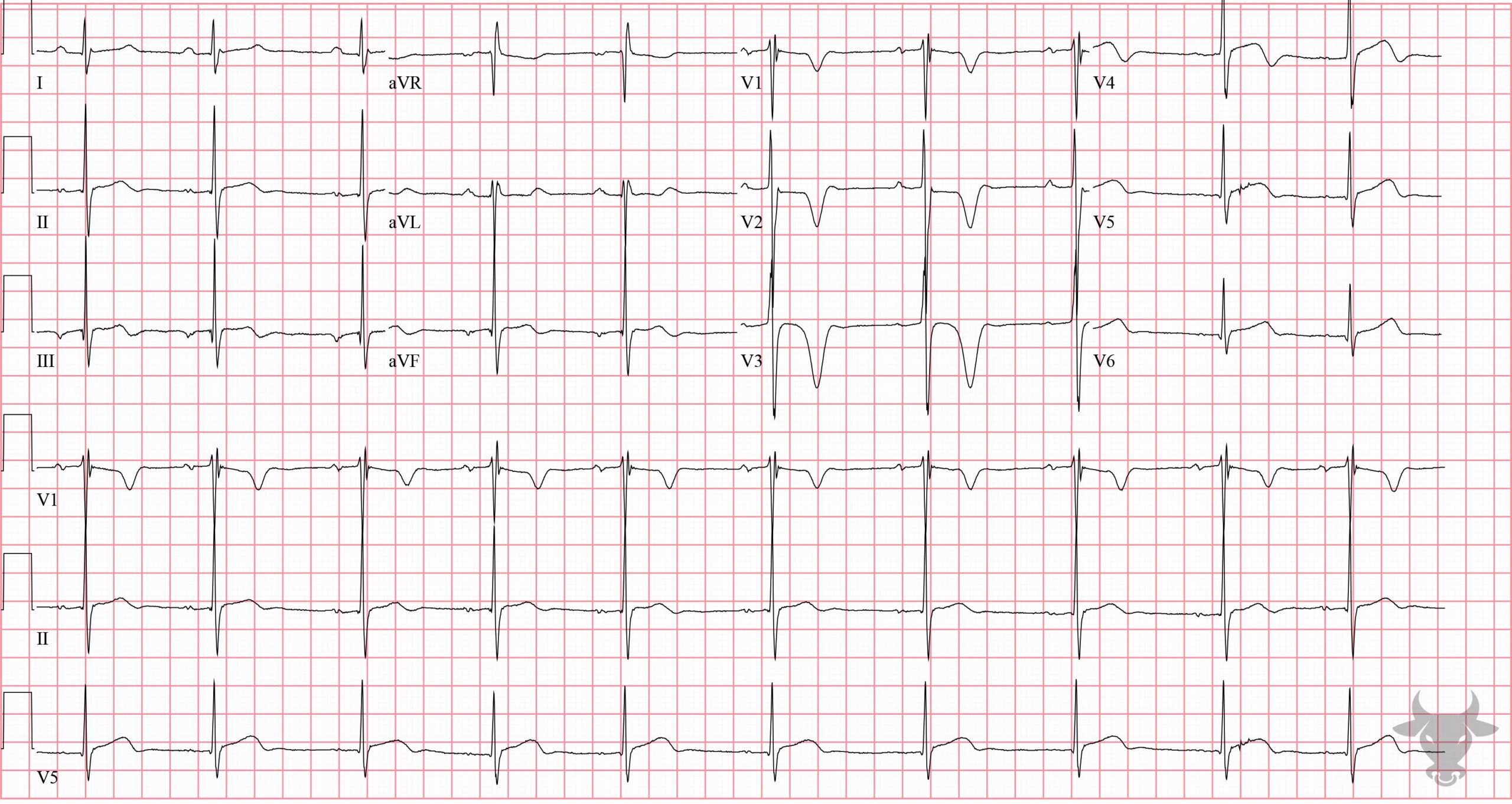 ECG Showing Hypertrophic Cardiomyopathy