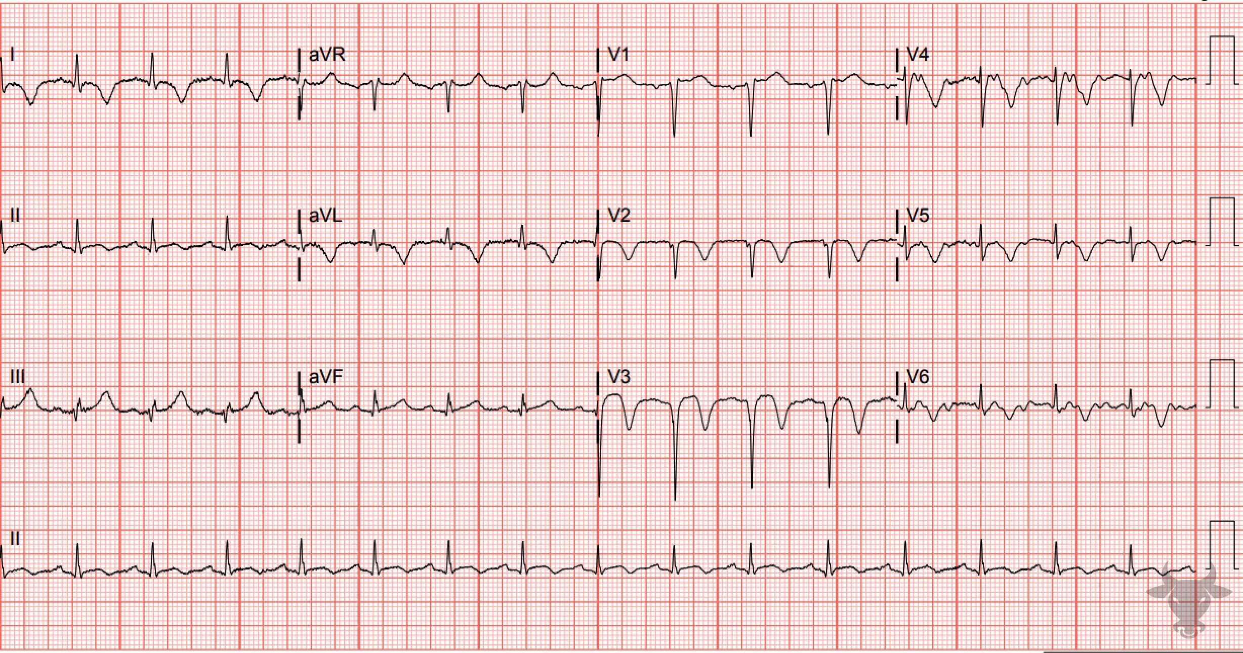 ECG Showing Wellens Syndrome