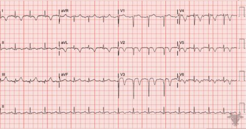T-wave Inversions | ECG Stampede