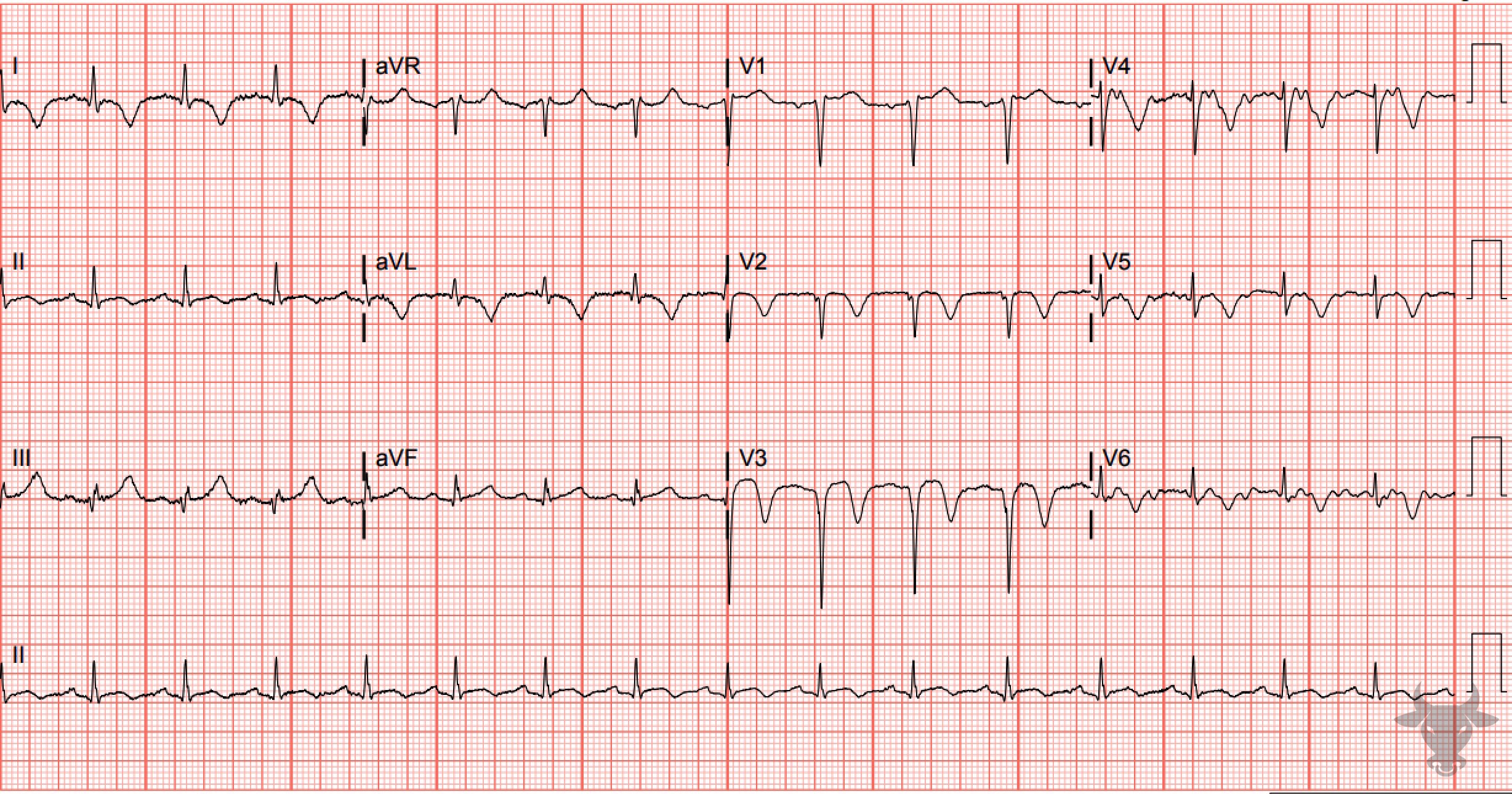 ECG Showing Wellens Syndrome