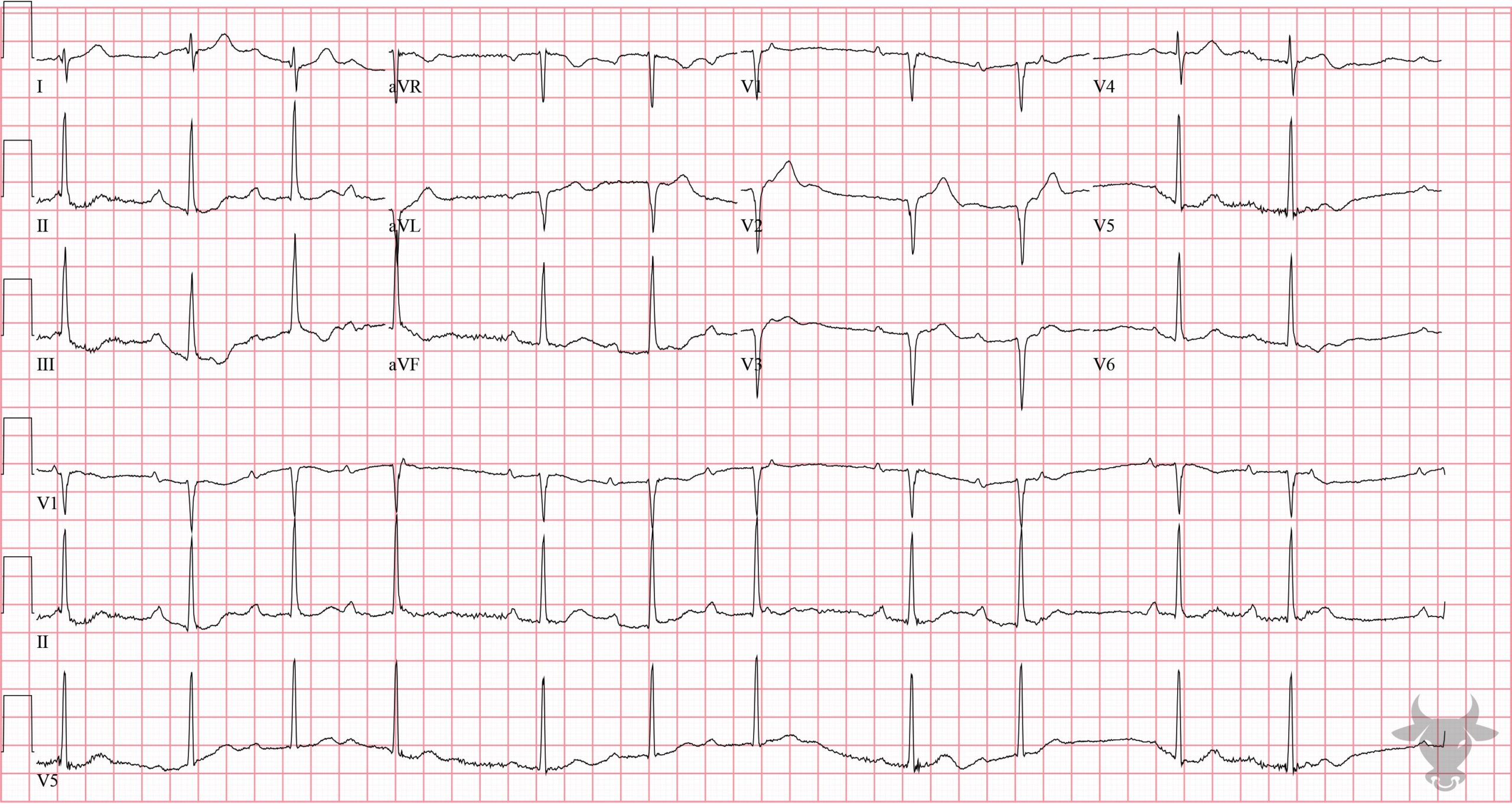 ECG Showing Second Degree Atrioventricular Block - Mobitz I