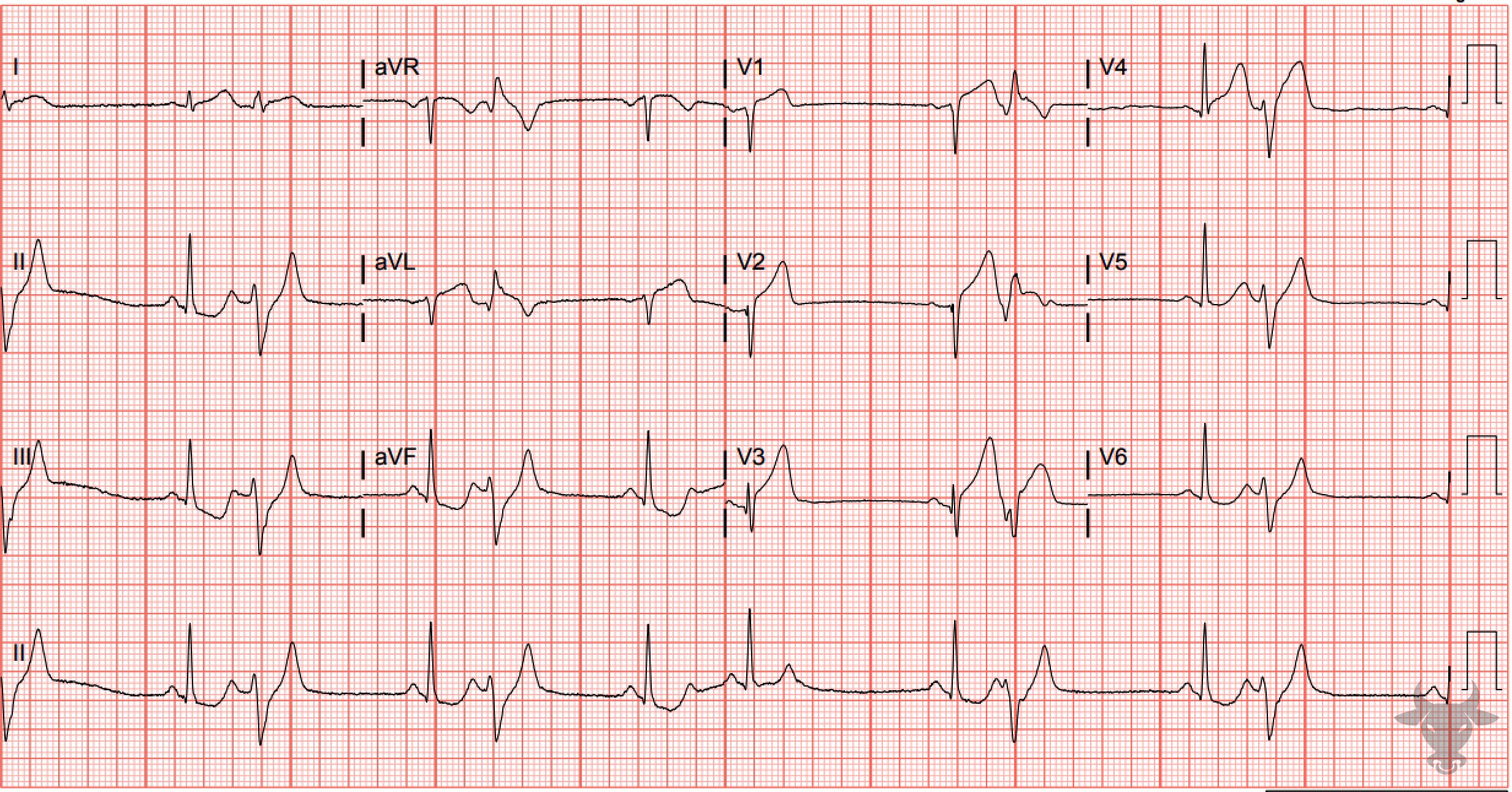 ECG Showing ST-elevation Myocardial Infarction