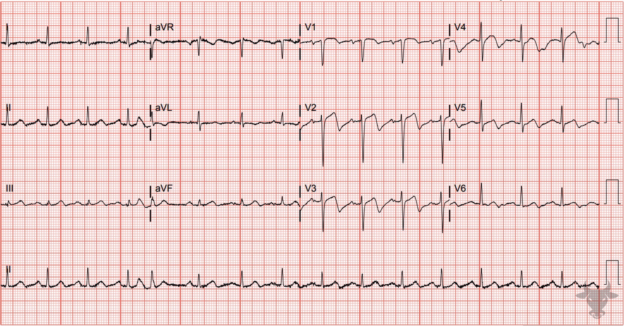 ECG Showing Wellens Syndrome