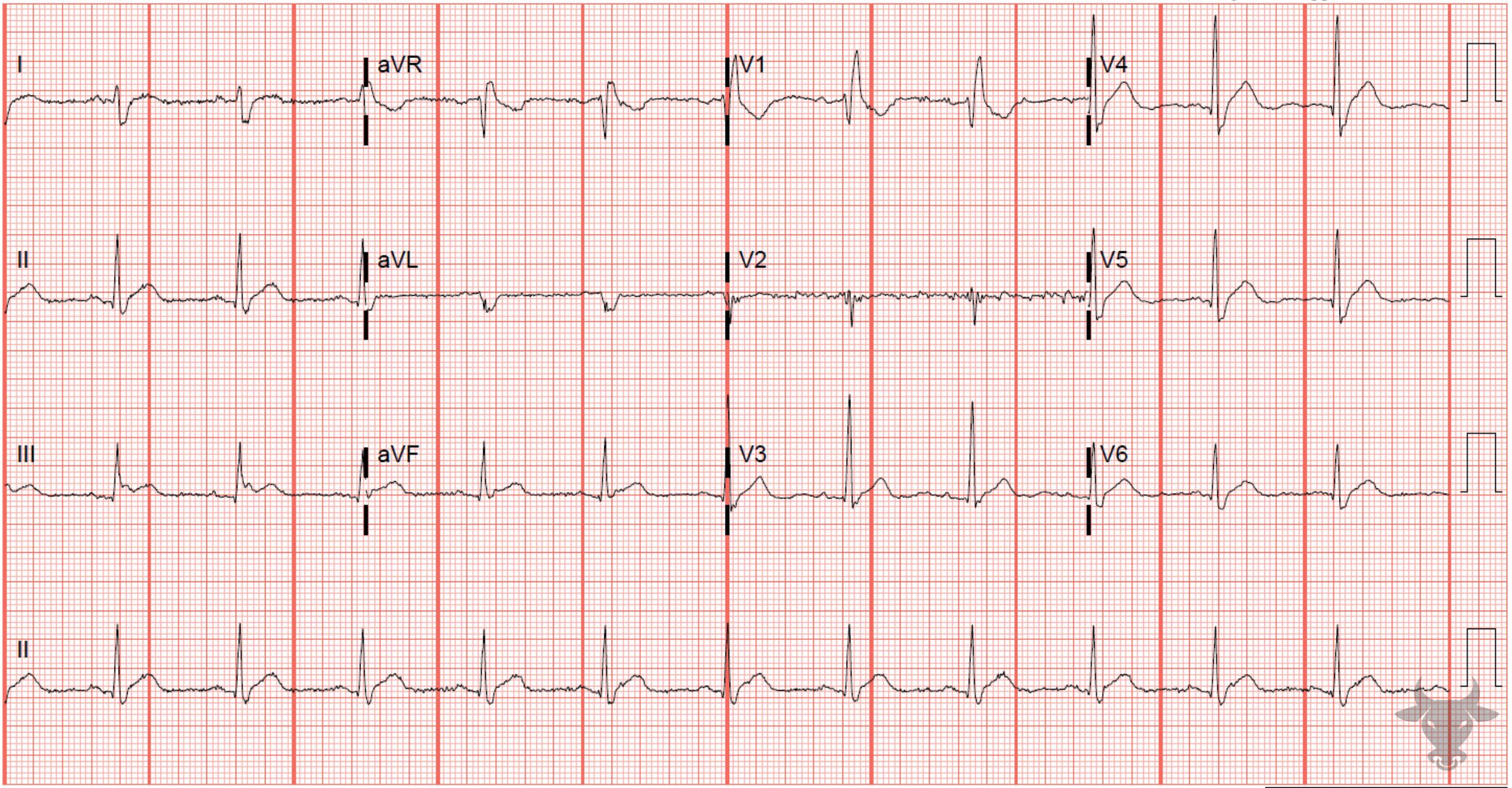 ECG Showing Hypercalcemia