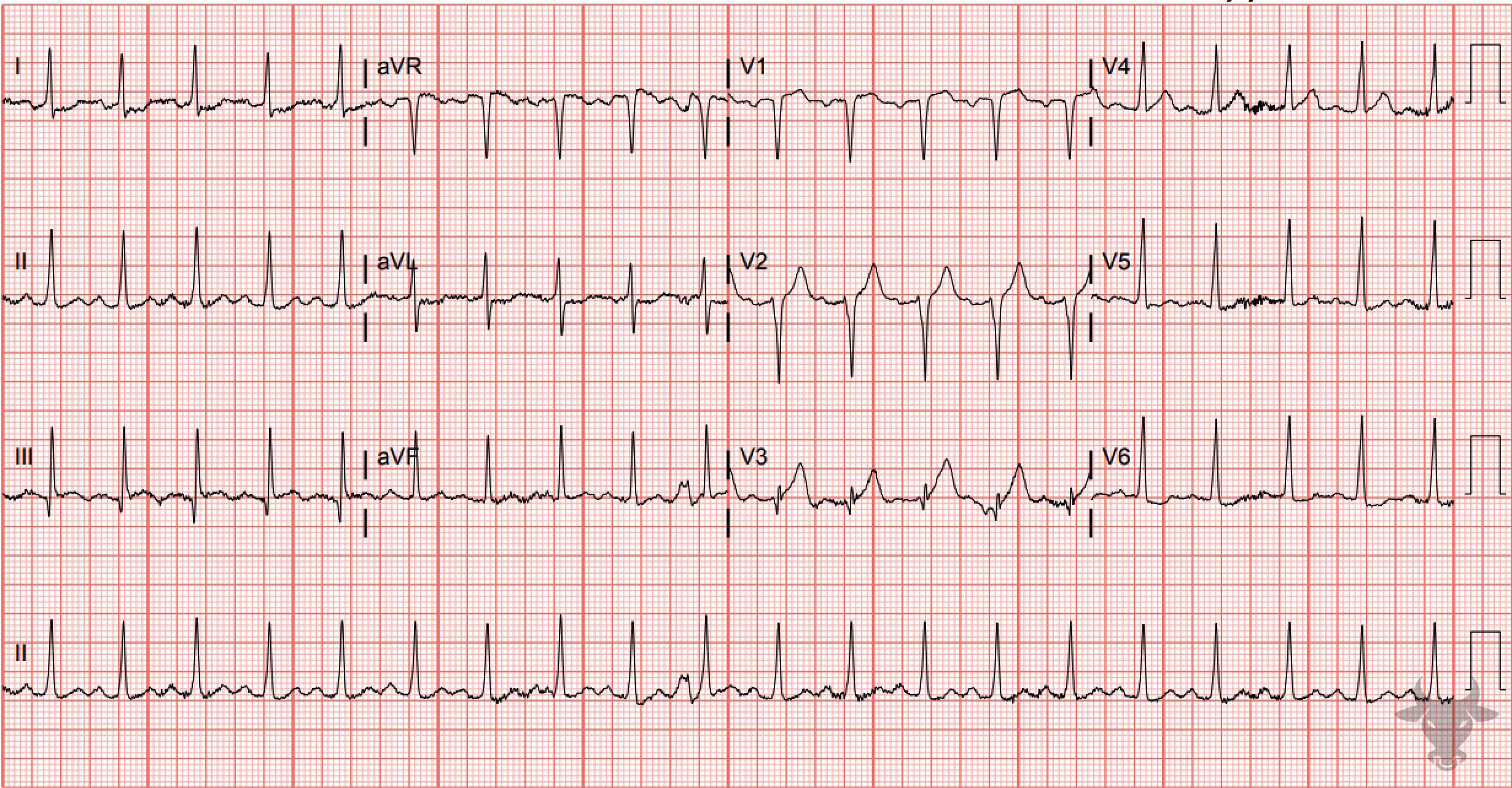 ECG Showing ST-elevation Myocardial Infarction