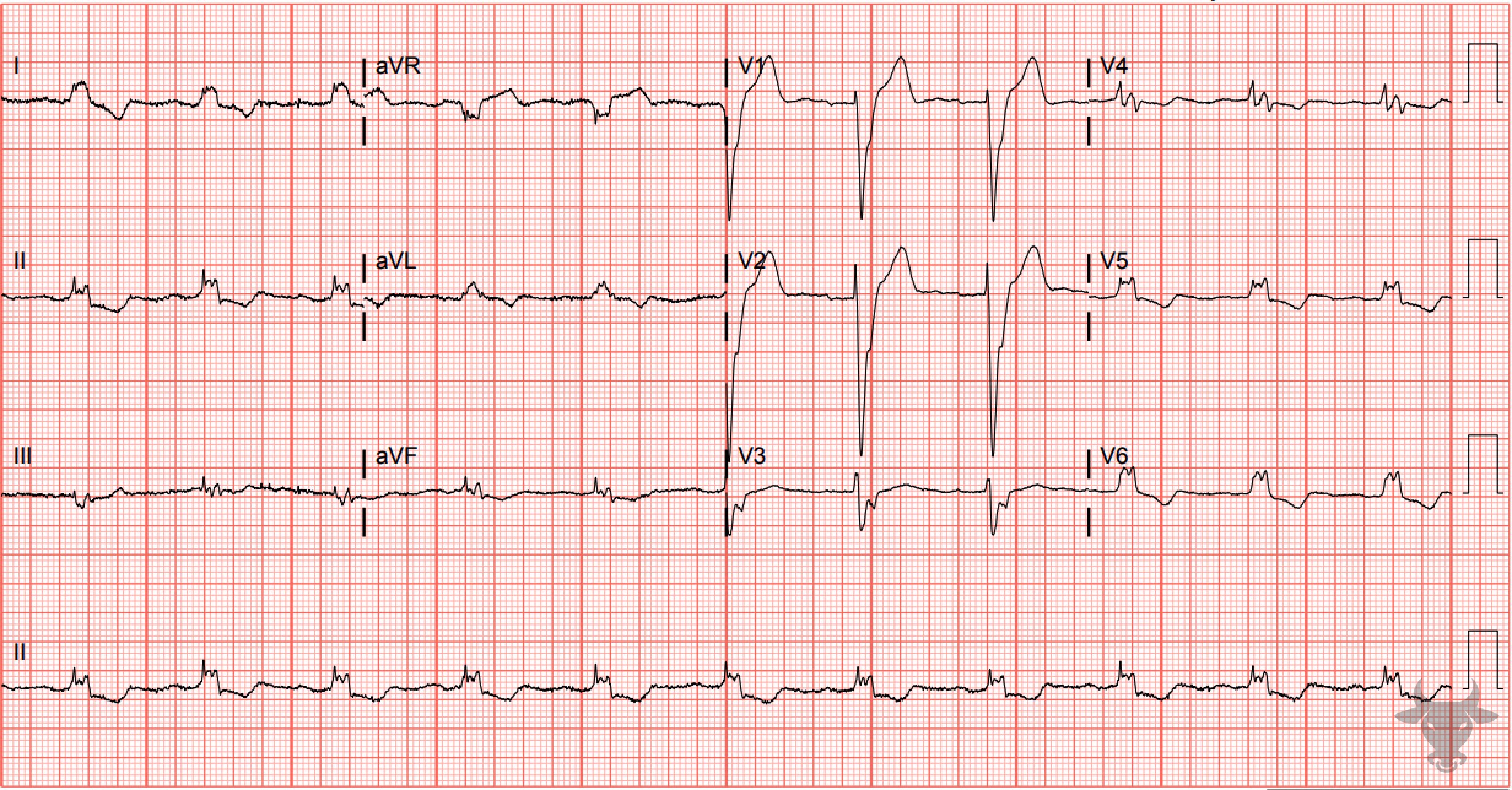 ECG Showing Left Bundle Branch Block