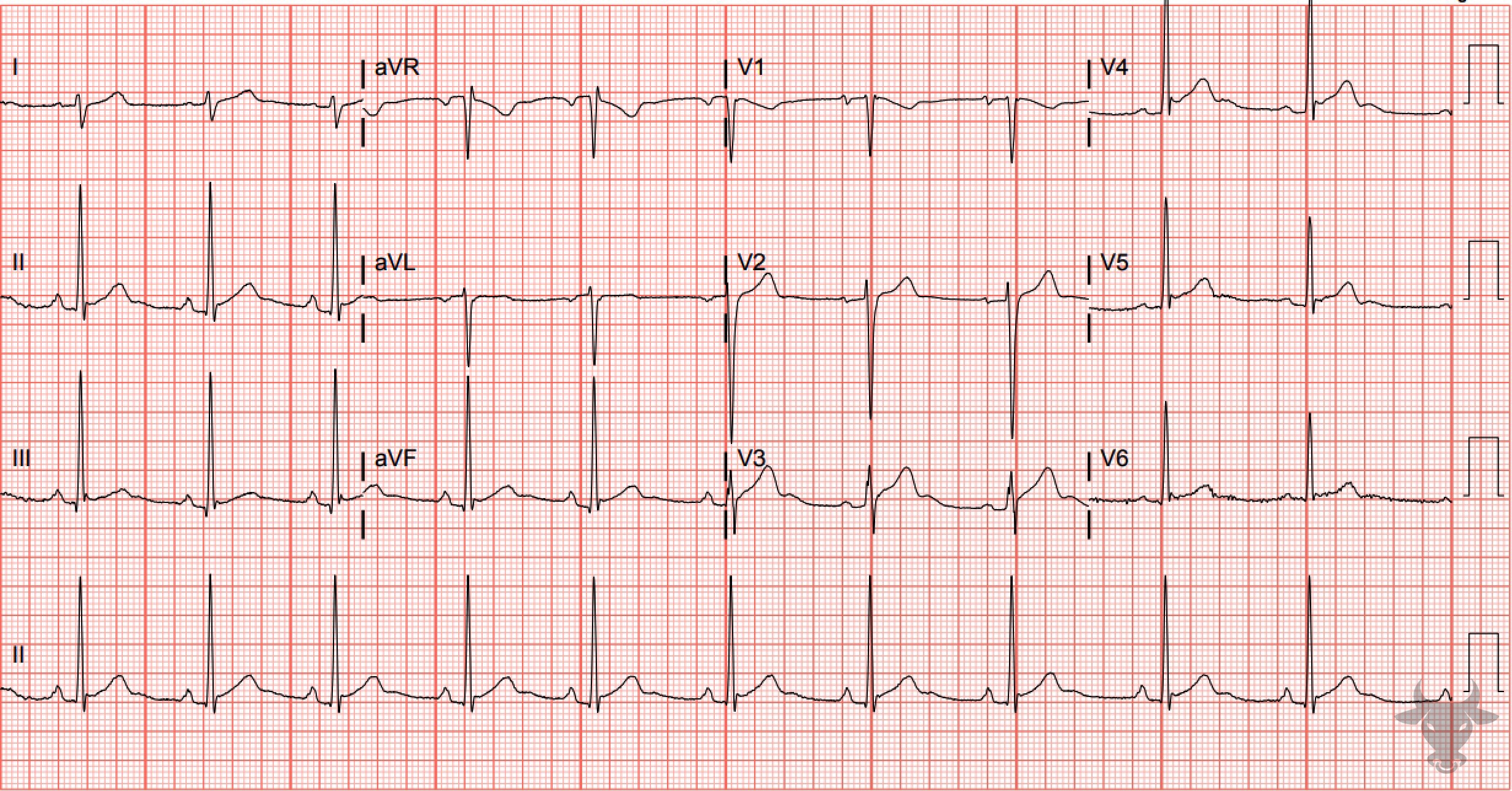 ECG Showing Early Repolarization