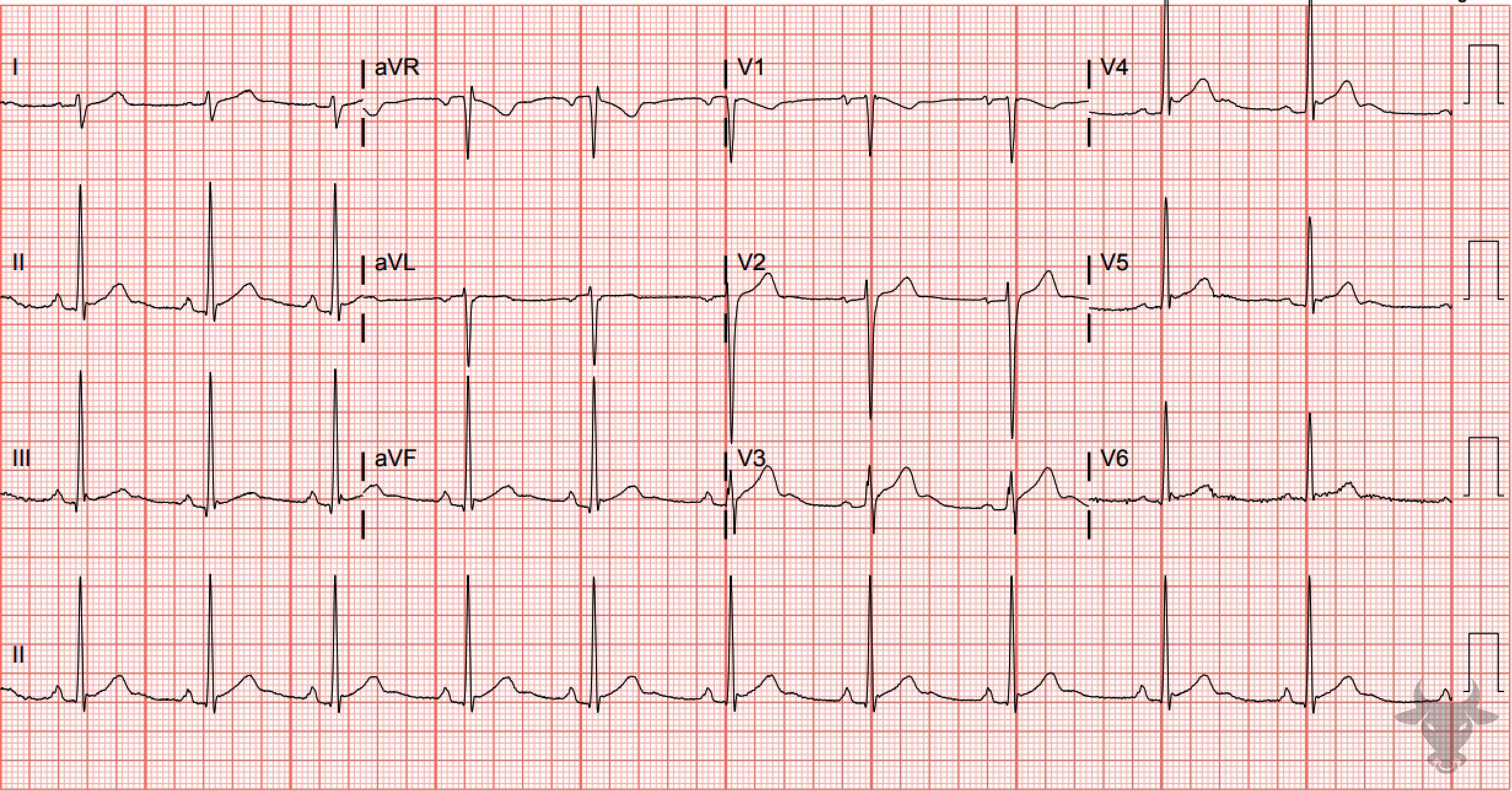 ECG Showing Early Repolarization