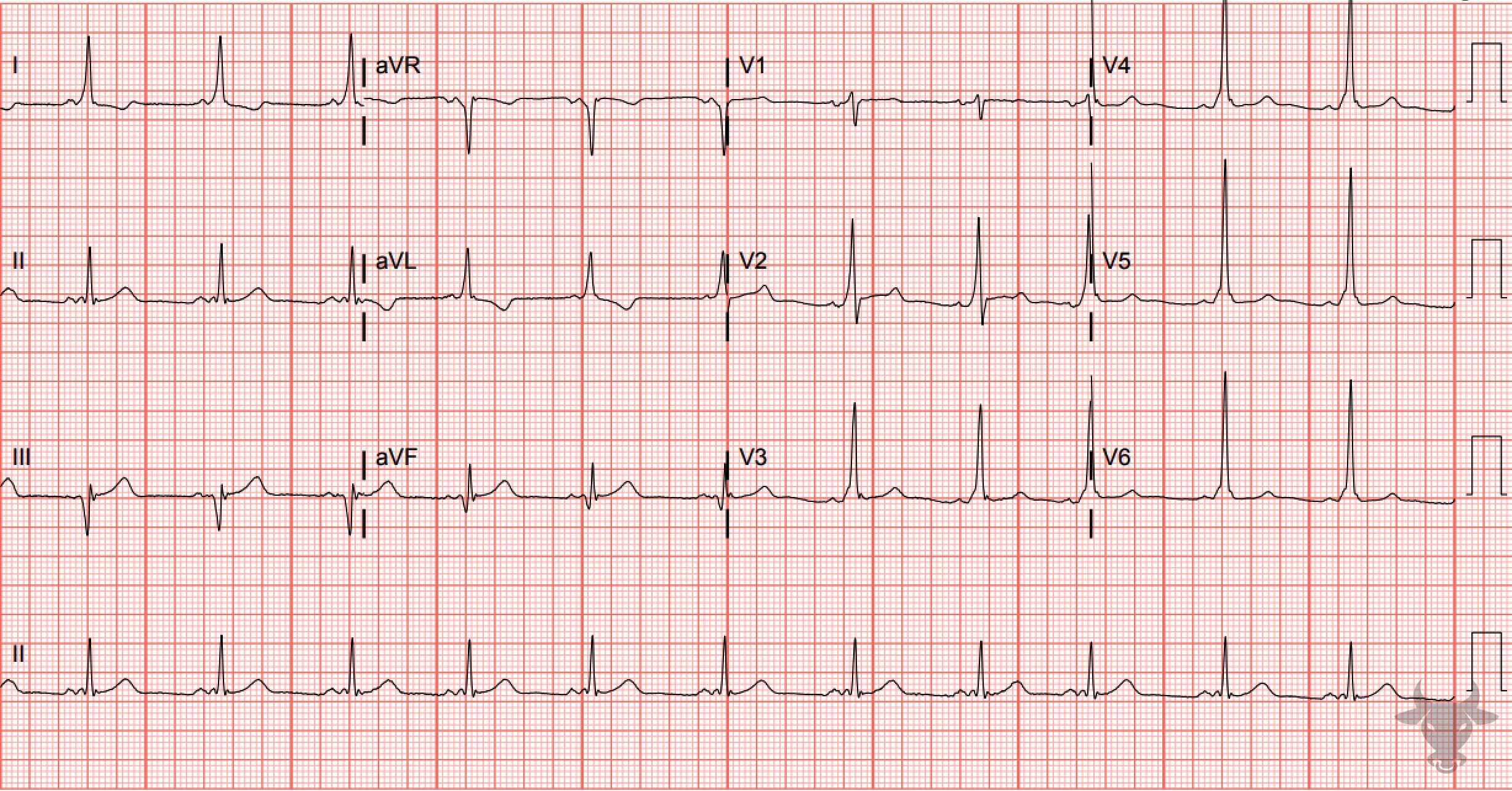 ECG Showing Ventricular Pre-excitation