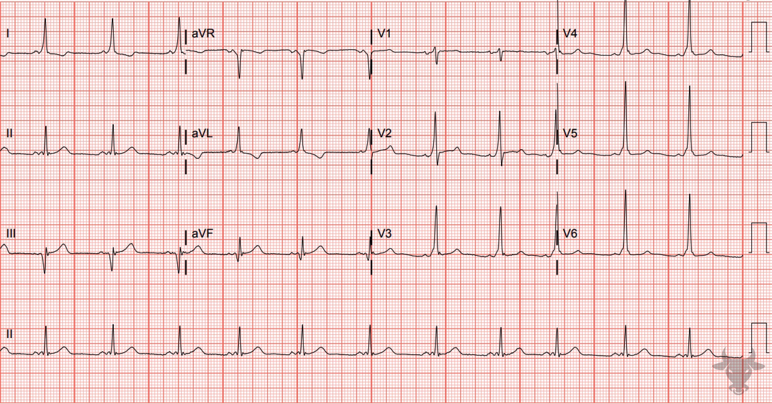 ECG Showing Ventricular Pre-excitation