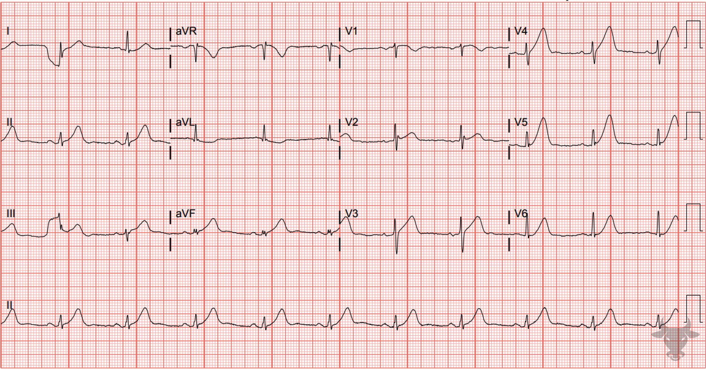 ECG Showing Hyperacute T Waves