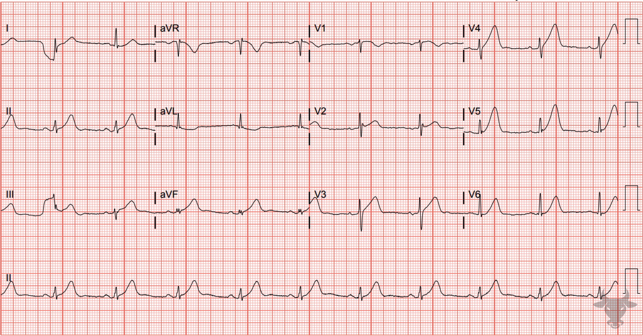 ECG Showing Hyperacute T Waves