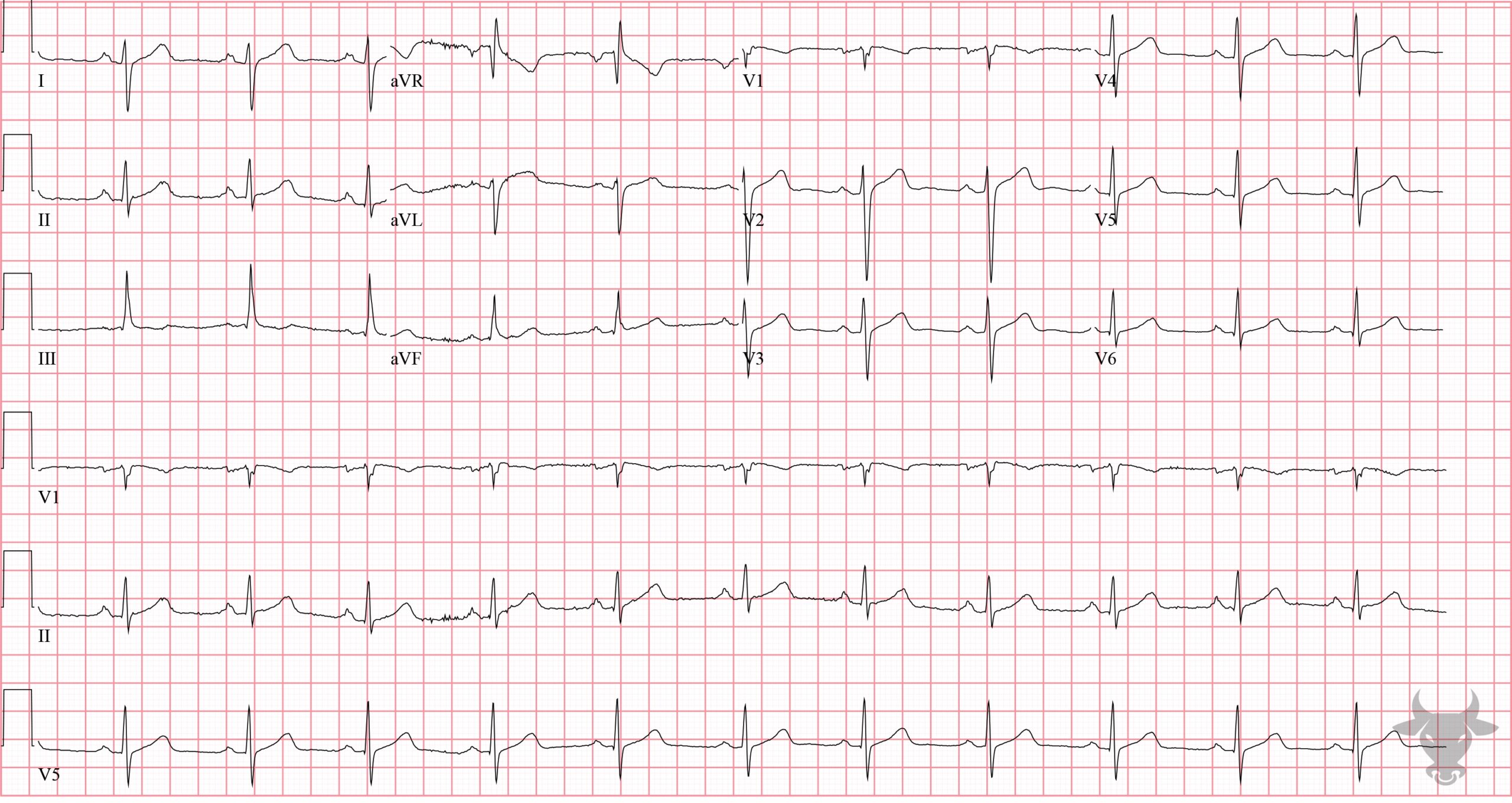 ECG Showing Left Posterior Fascicular Block