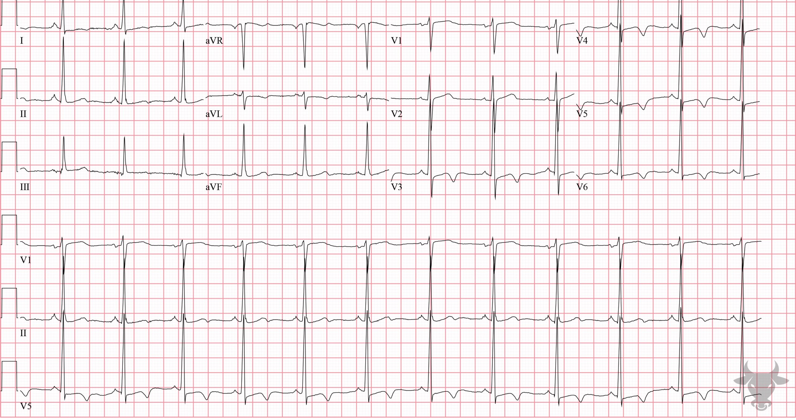 ECG Showing Hypertrophic Cardiomyopathy