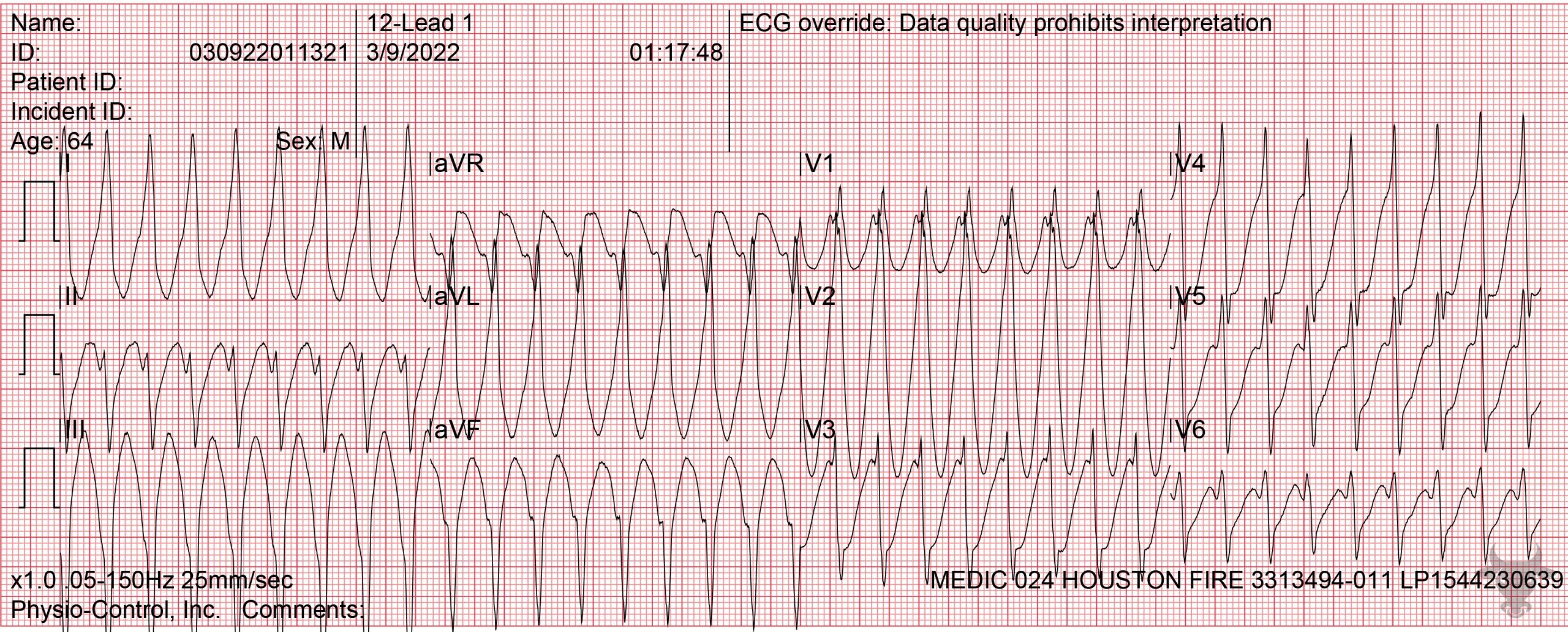 ECG Showing Ventricular Tachycardia