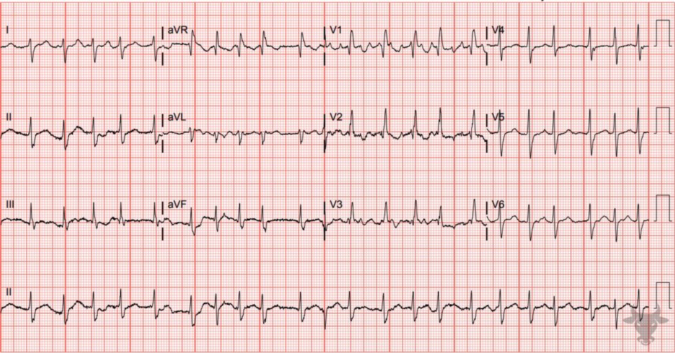 Bifascicular Block ECG Stampede