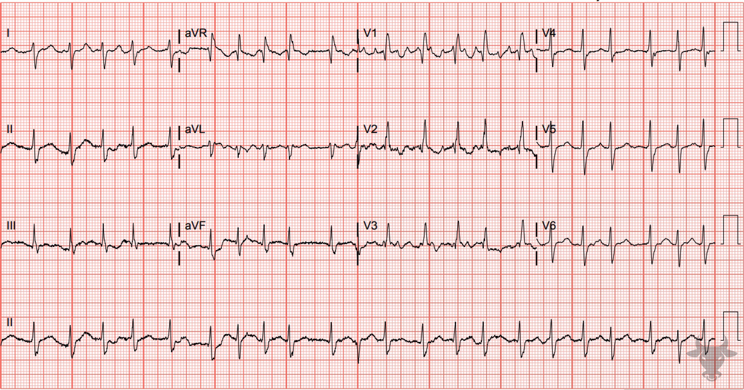 ECG Showing Bifascicular Block