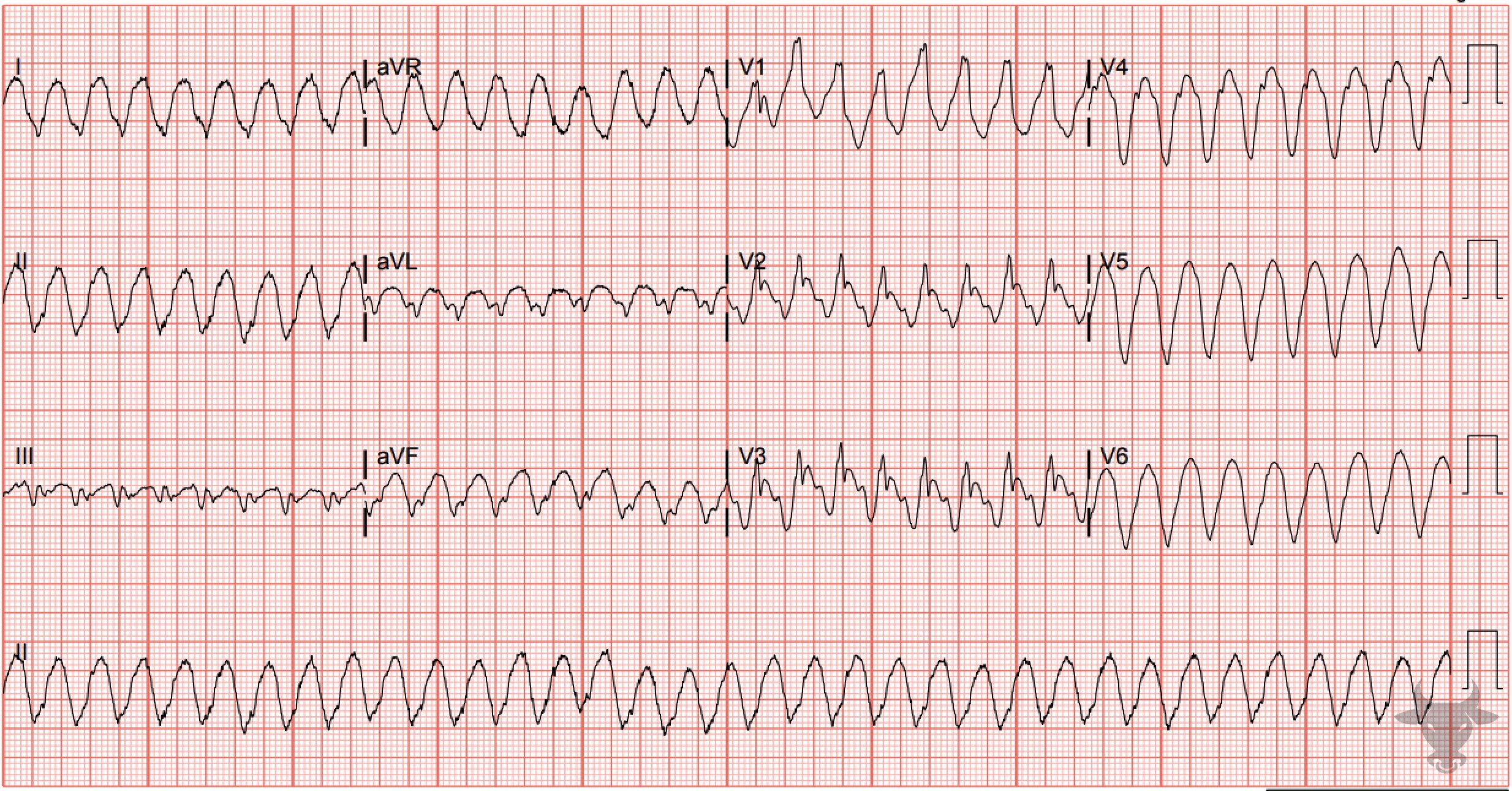 ECG Showing Ventricular Tachycardia