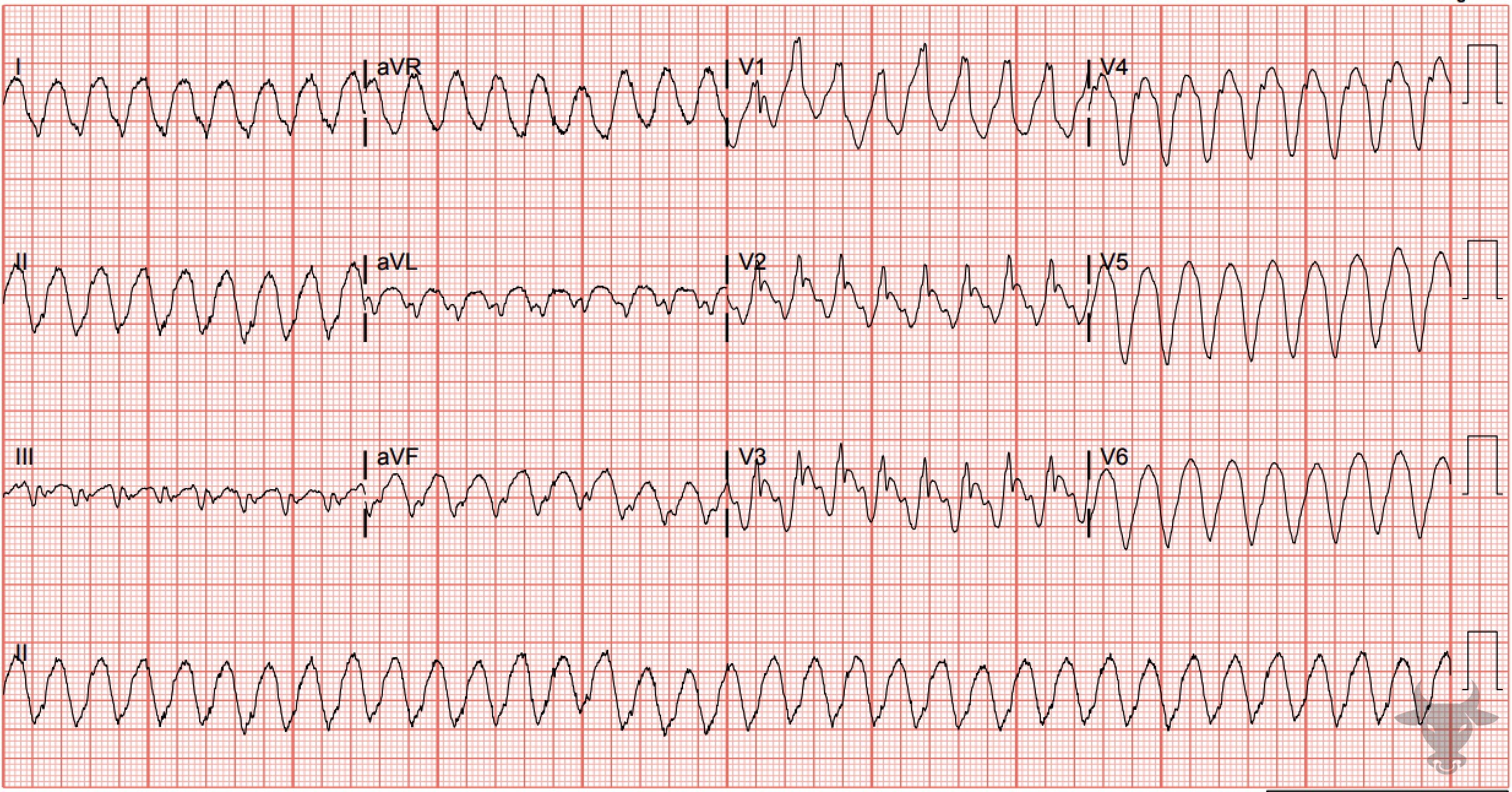 ECG Showing Ventricular Tachycardia