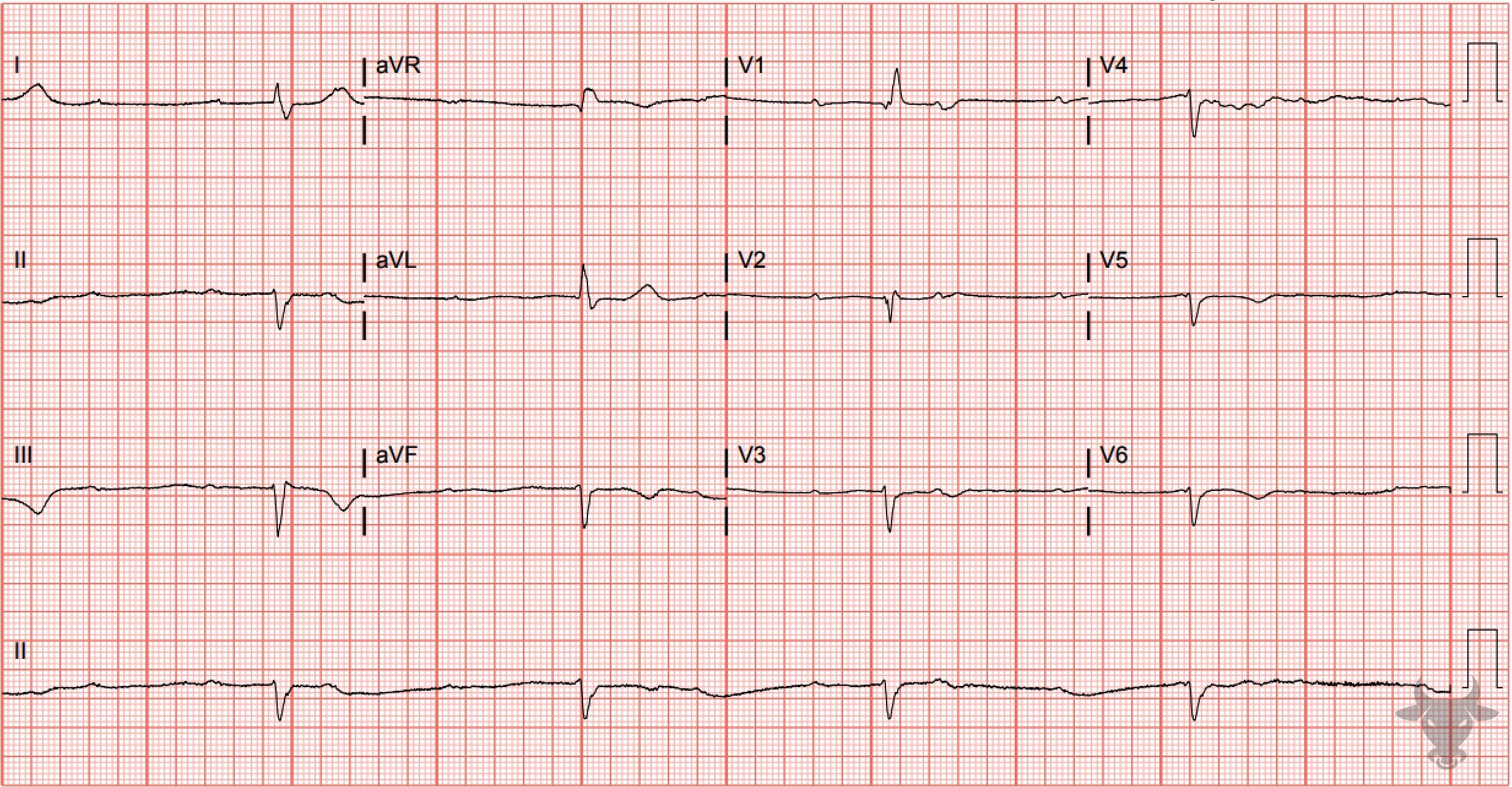 ECG Showing Third Degree Atrioventricular Block