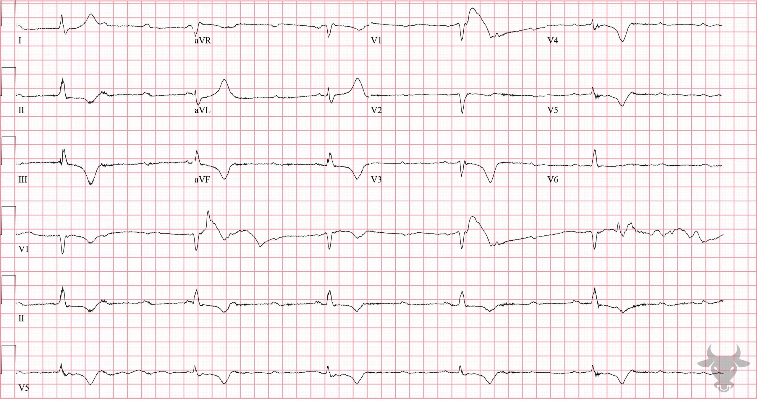 ECG Showing Third Degree Atrioventricular Block