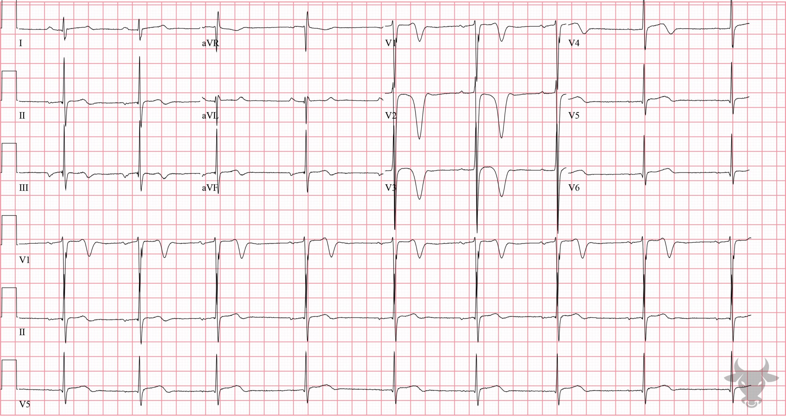 ECG Showing Hypertrophic Cardiomyopathy