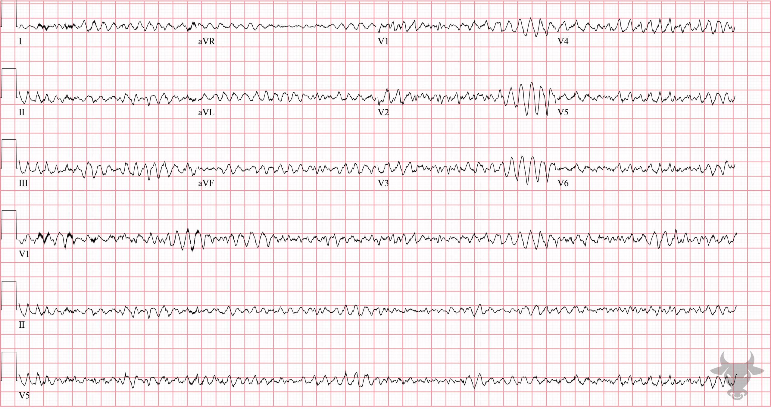 ECG Showing Ventricular Fibrillation