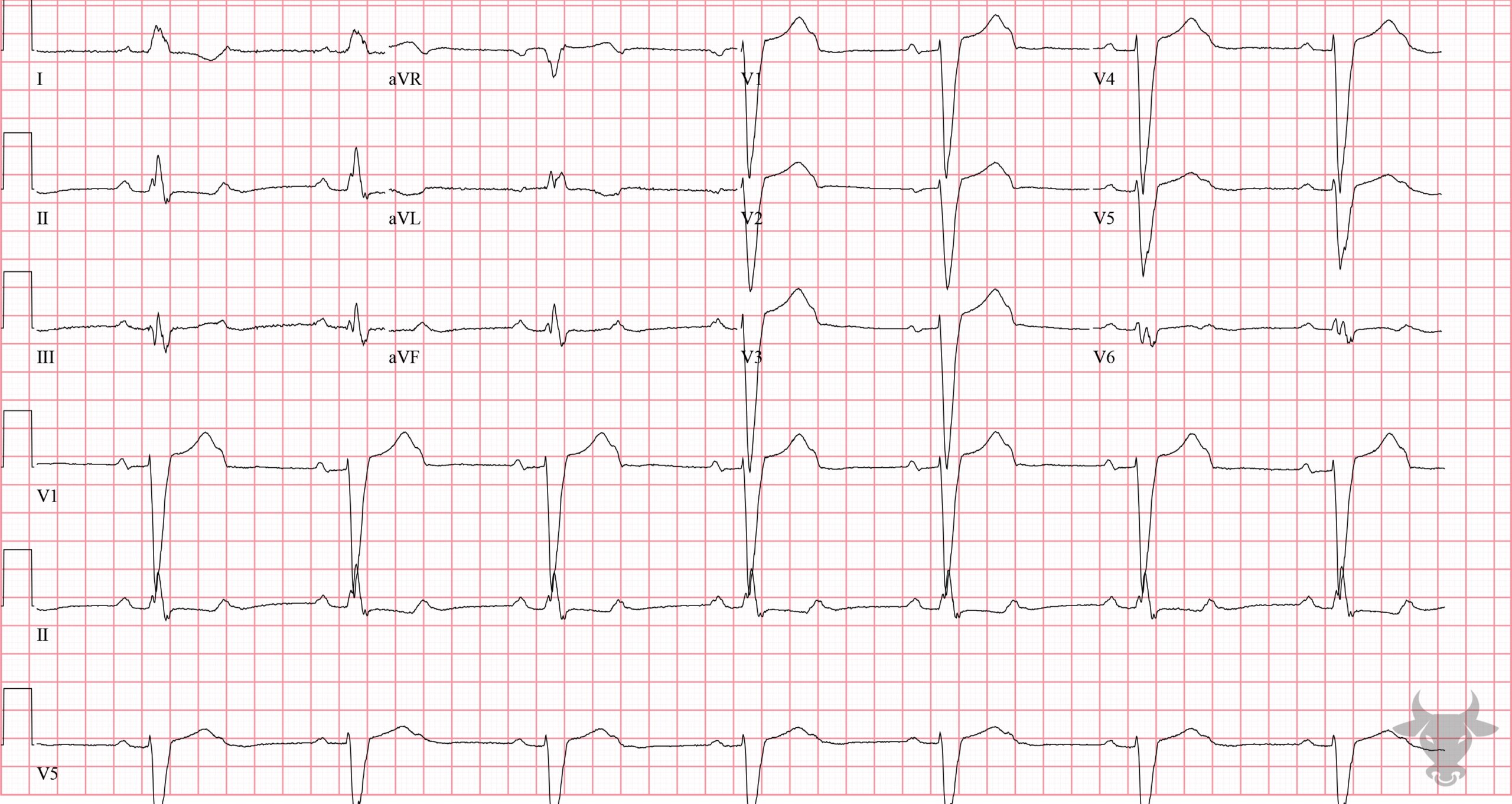 ECG Showing Second Degree Atrioventricular Block 2:1