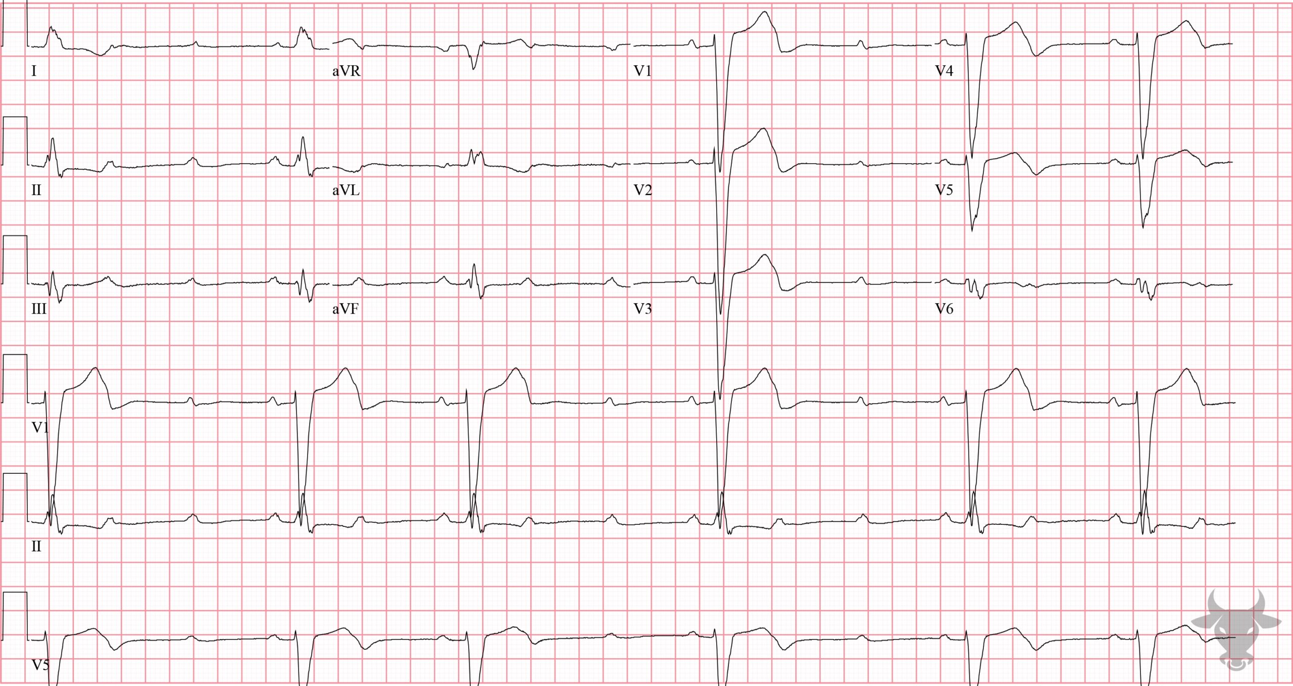 ECG Showing Second Degree Atrioventricular Block - Mobitz II