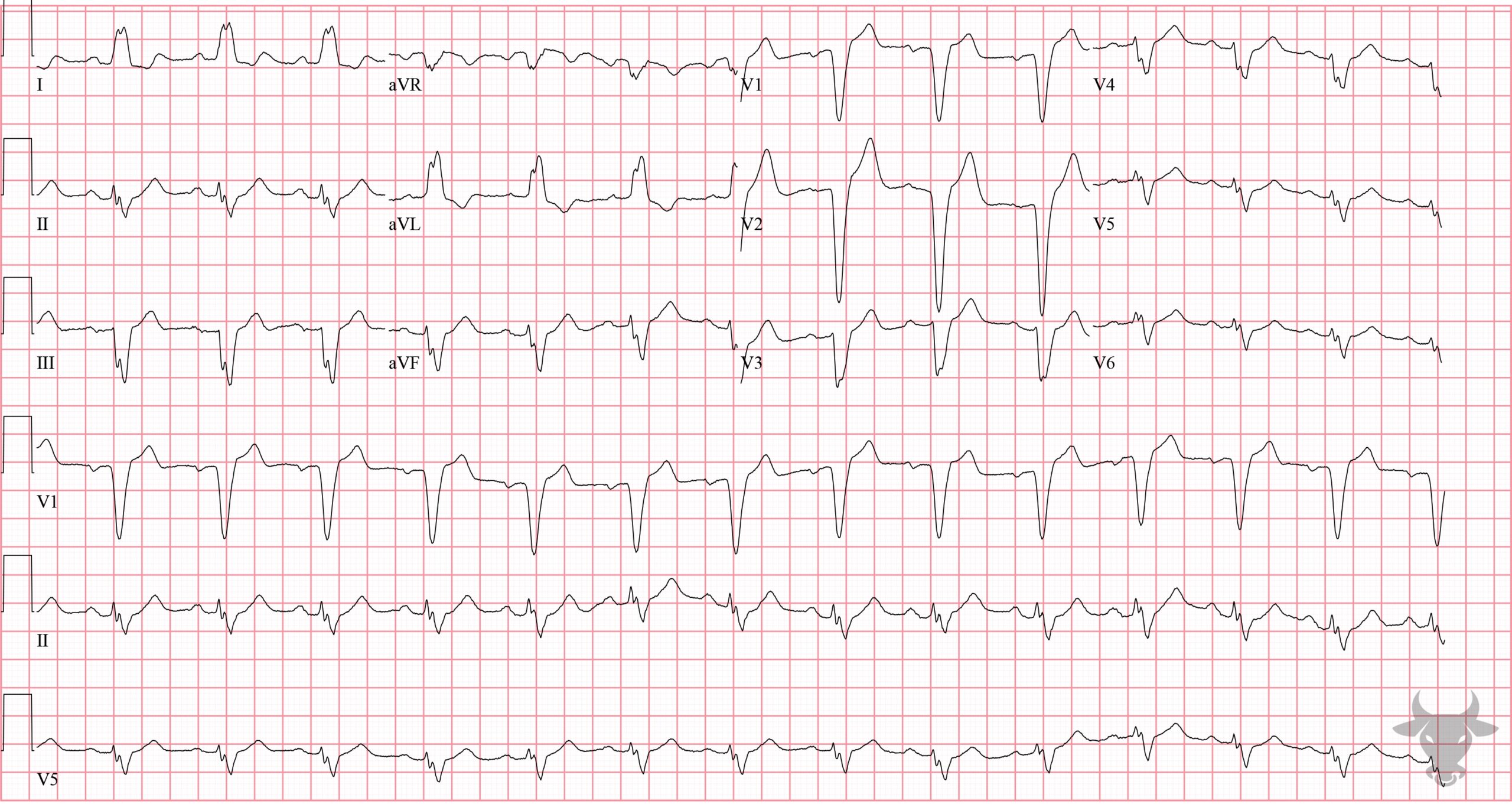 ECG Showing Left Bundle Branch Block