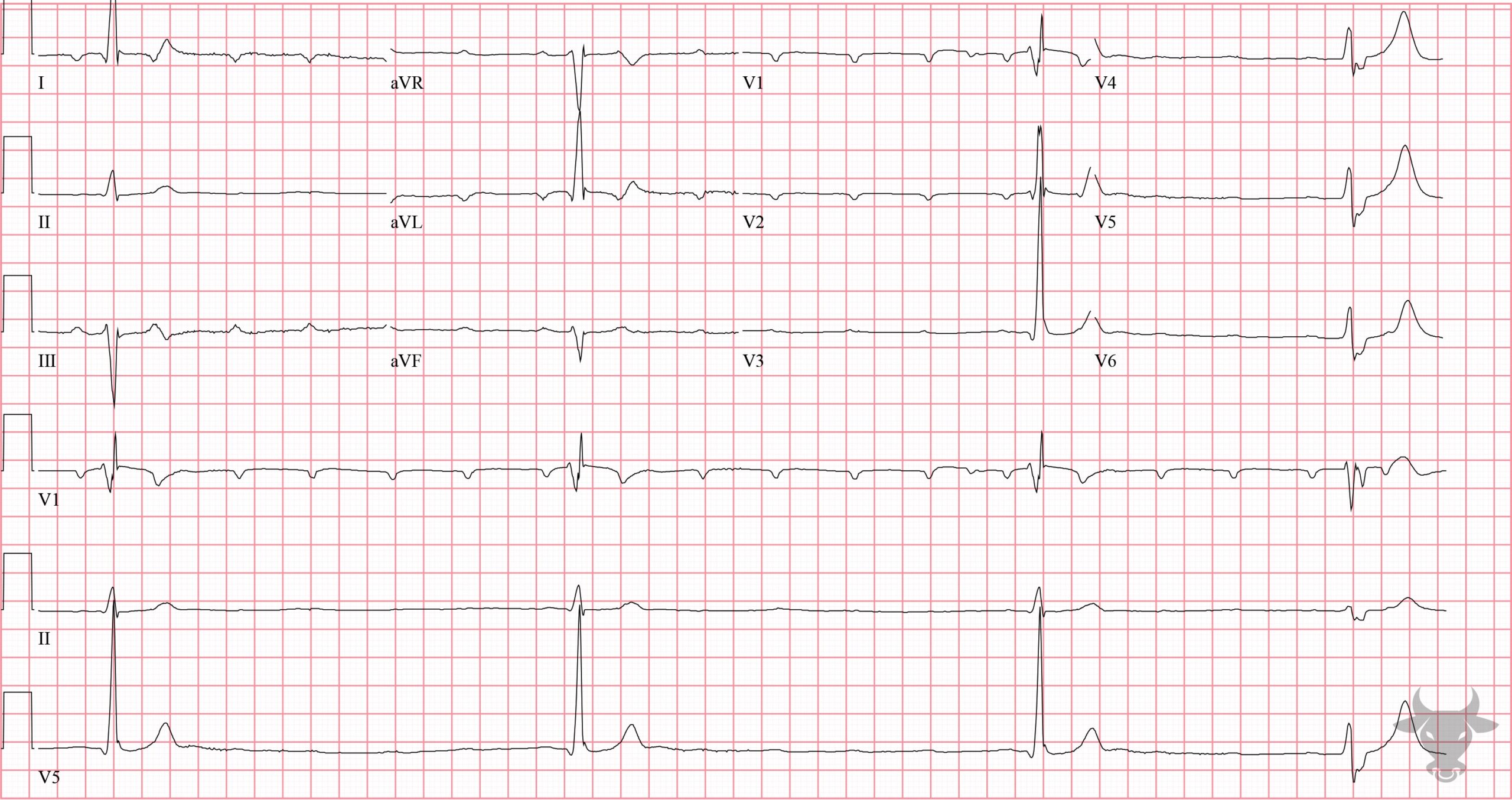 ECG Showing Third Degree Atrioventricular Block