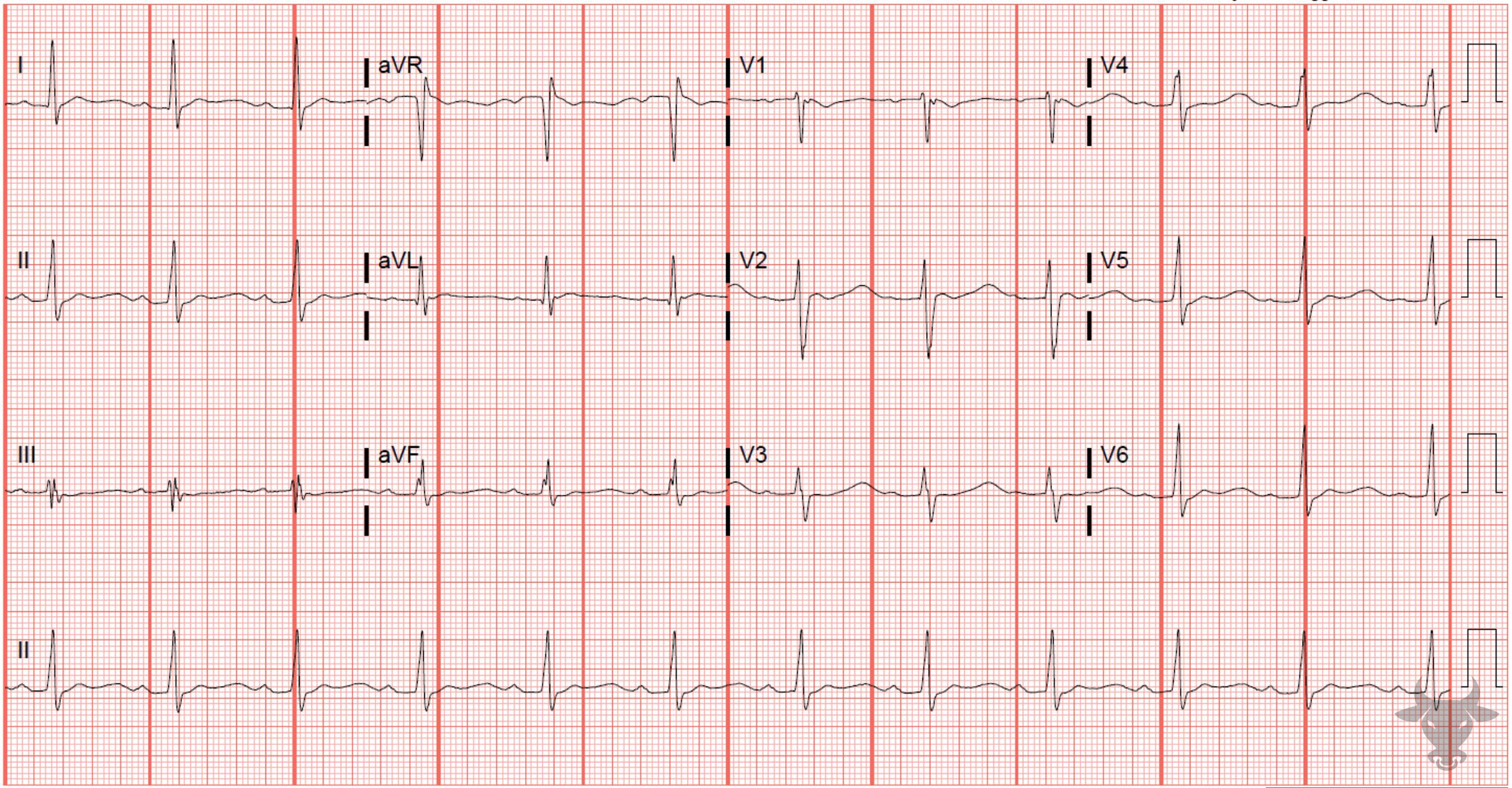 ECG Showing Hypokalemia