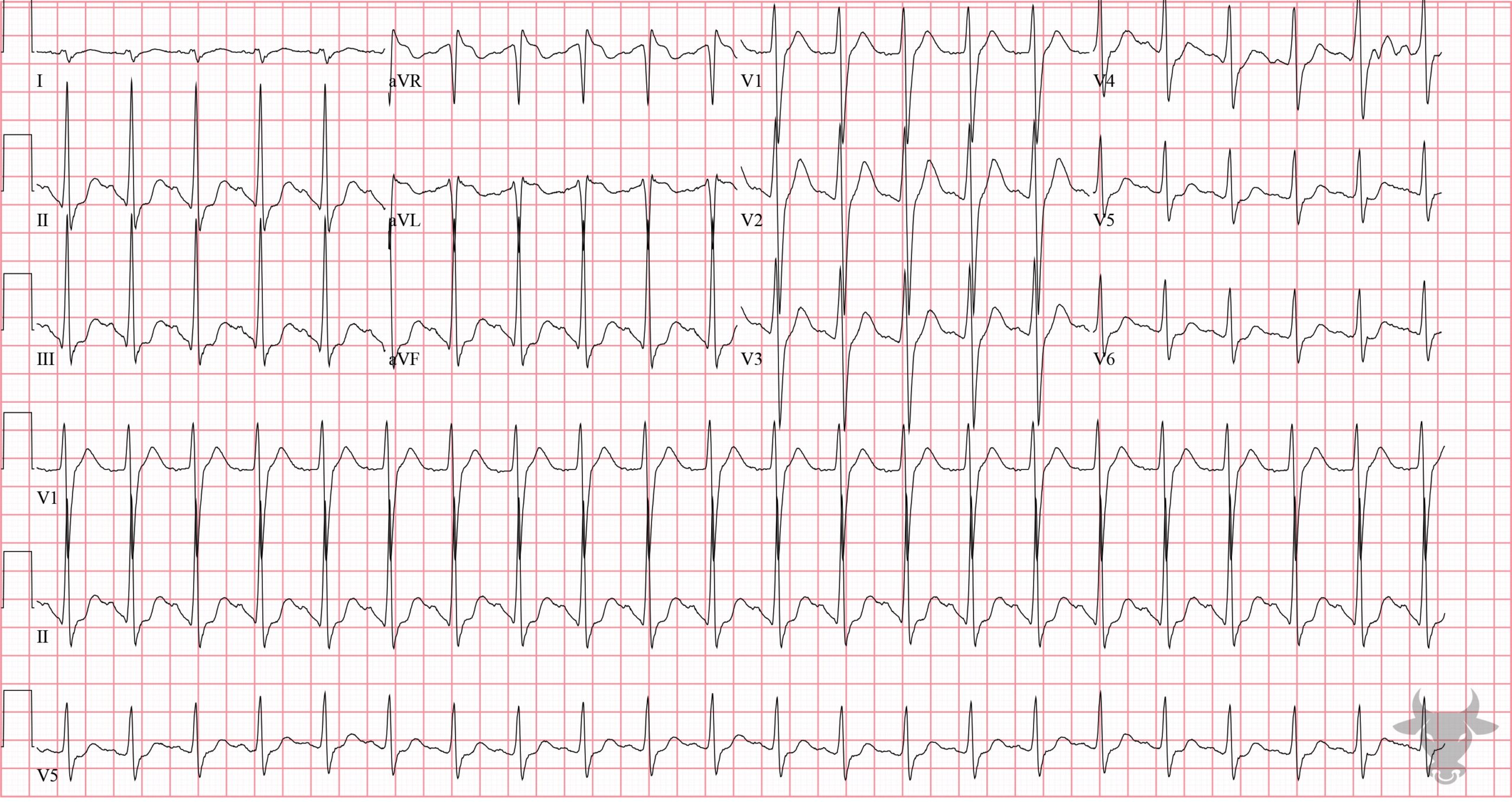 ECG Showing Sodium Channel Toxicity