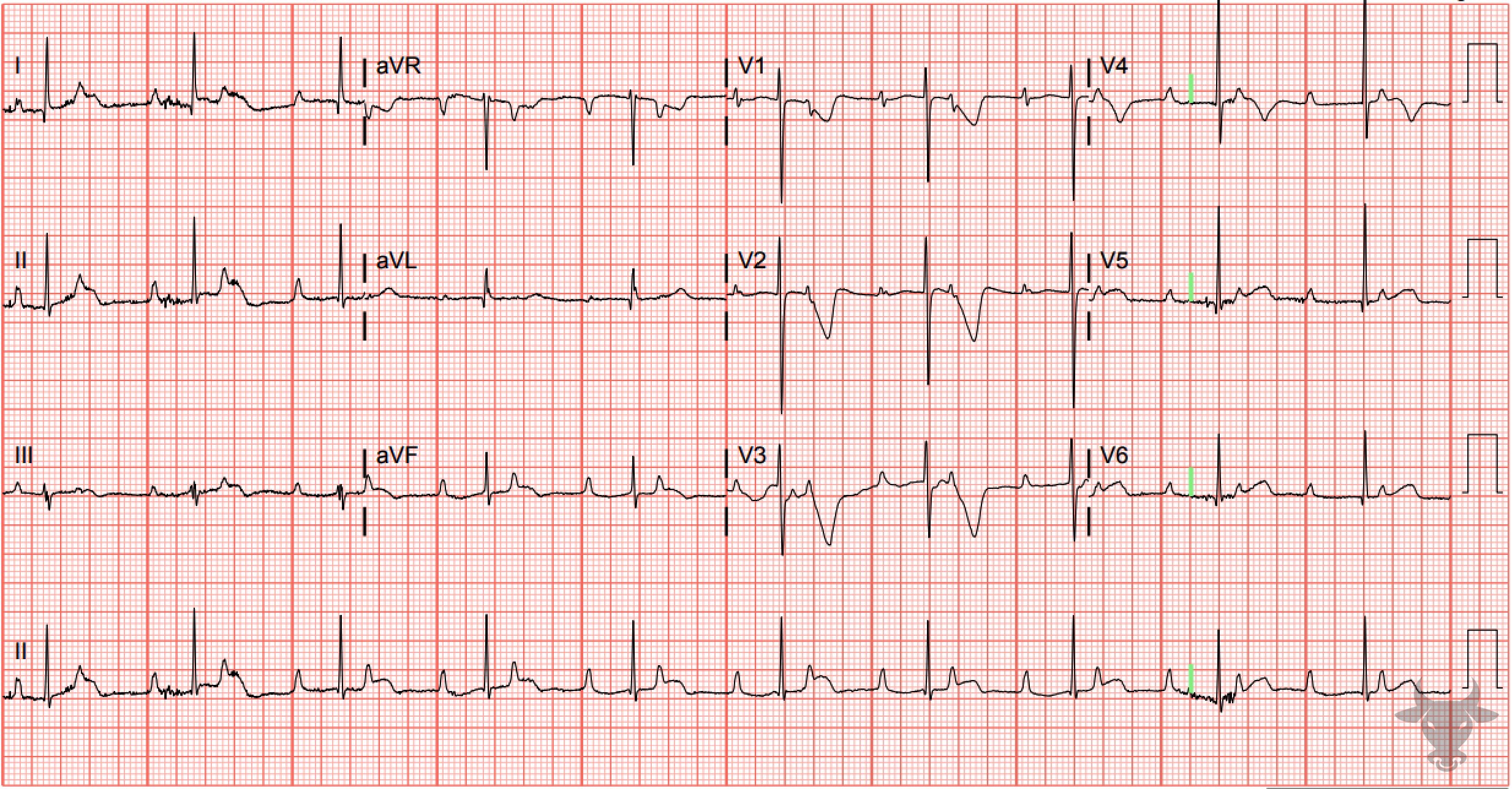 ECG Showing Third Degree Atrioventricular Block