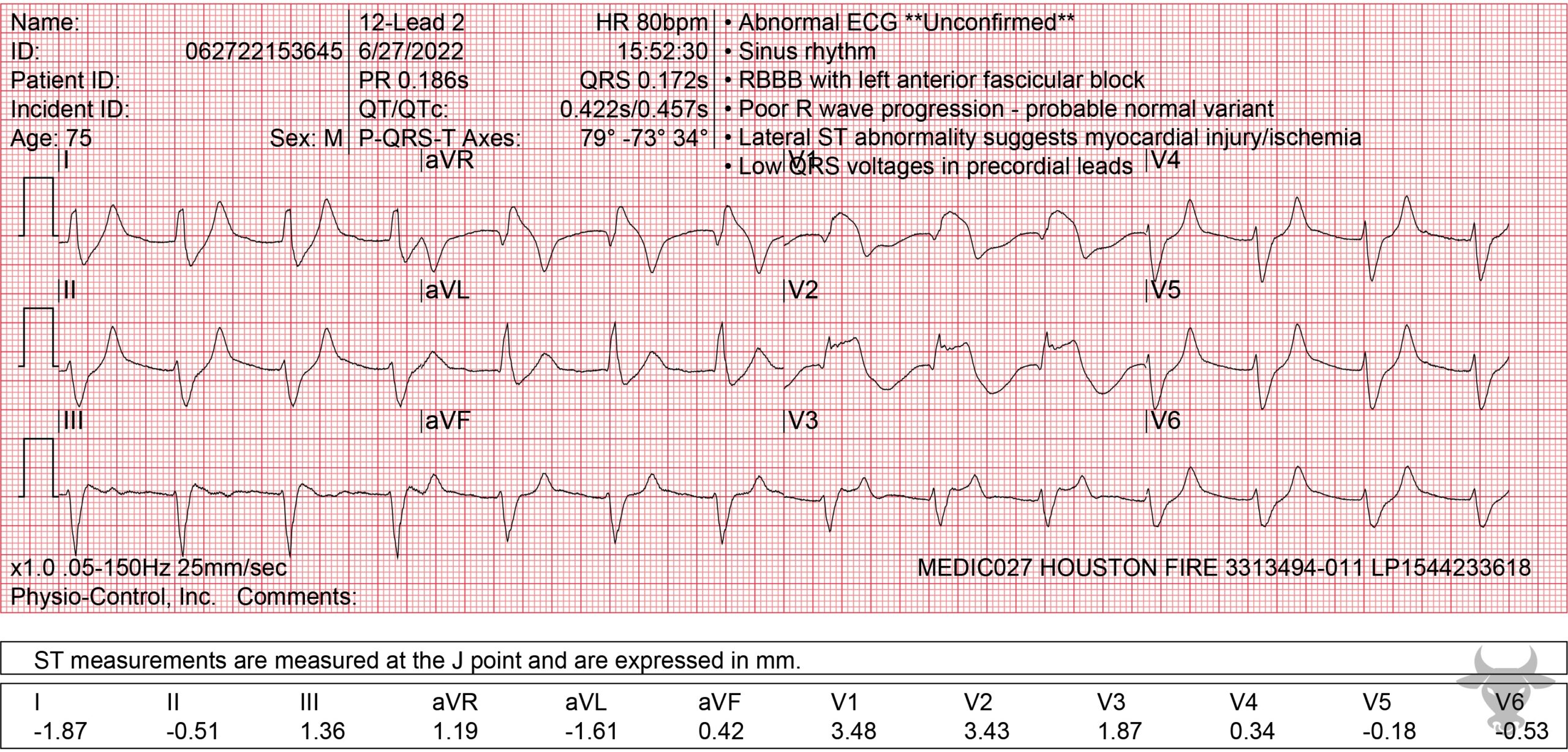 ECG Showing Hyperkalemia