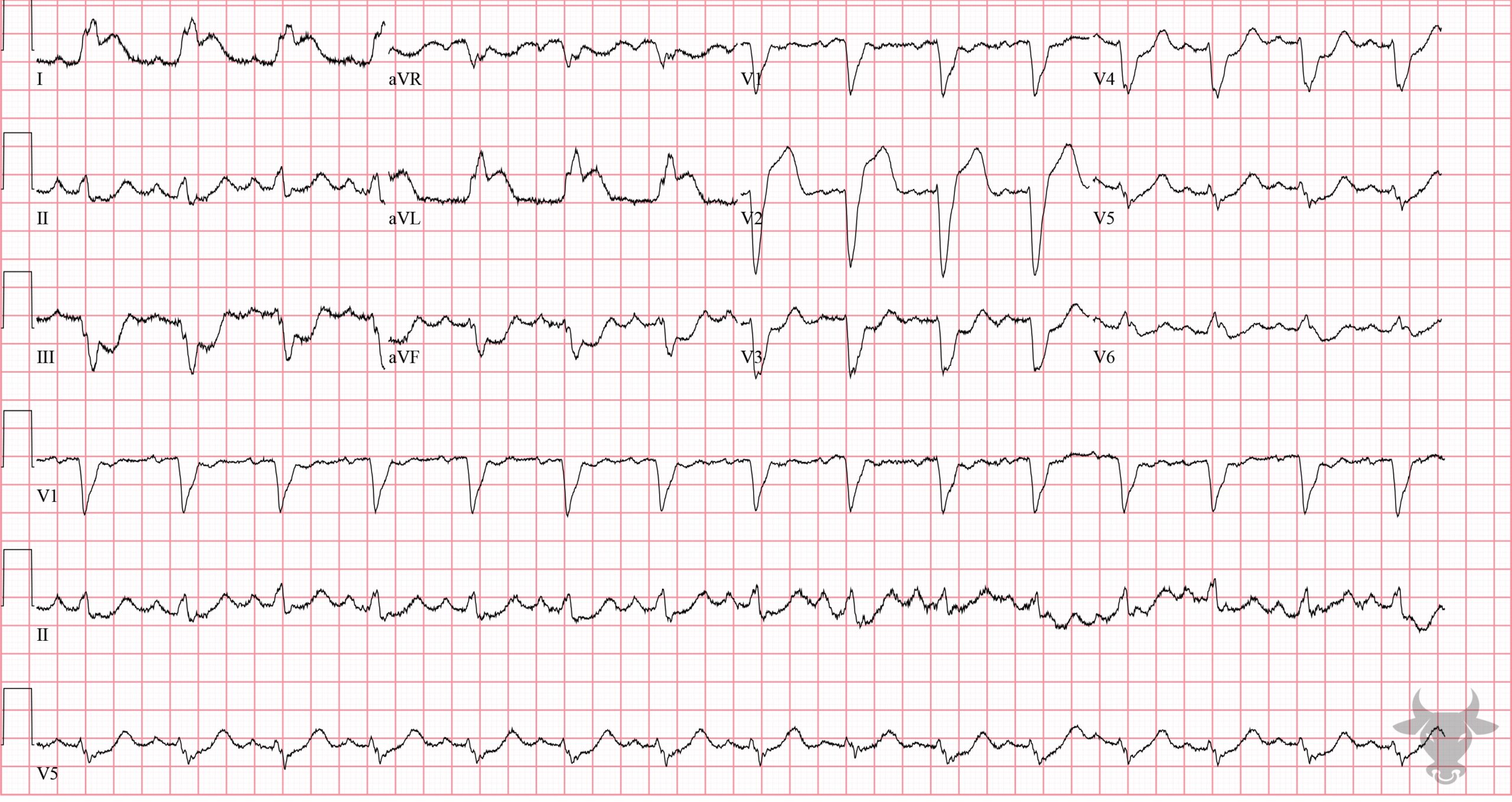 ECG Showing Sgarbossa Criteria